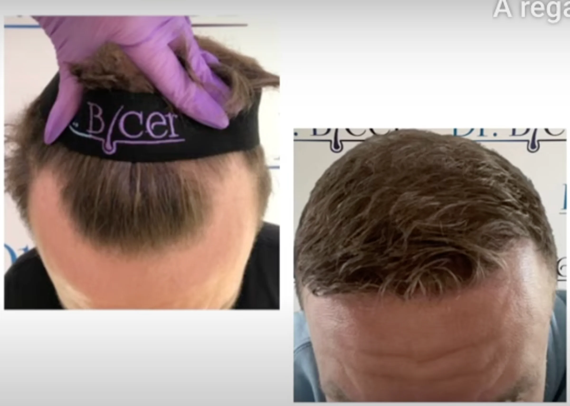 Dr Ozlem Bicer, Istanbul, Turkey - Gulfs, Frontal area, Crown / Vertex - FUE motorized : 3650