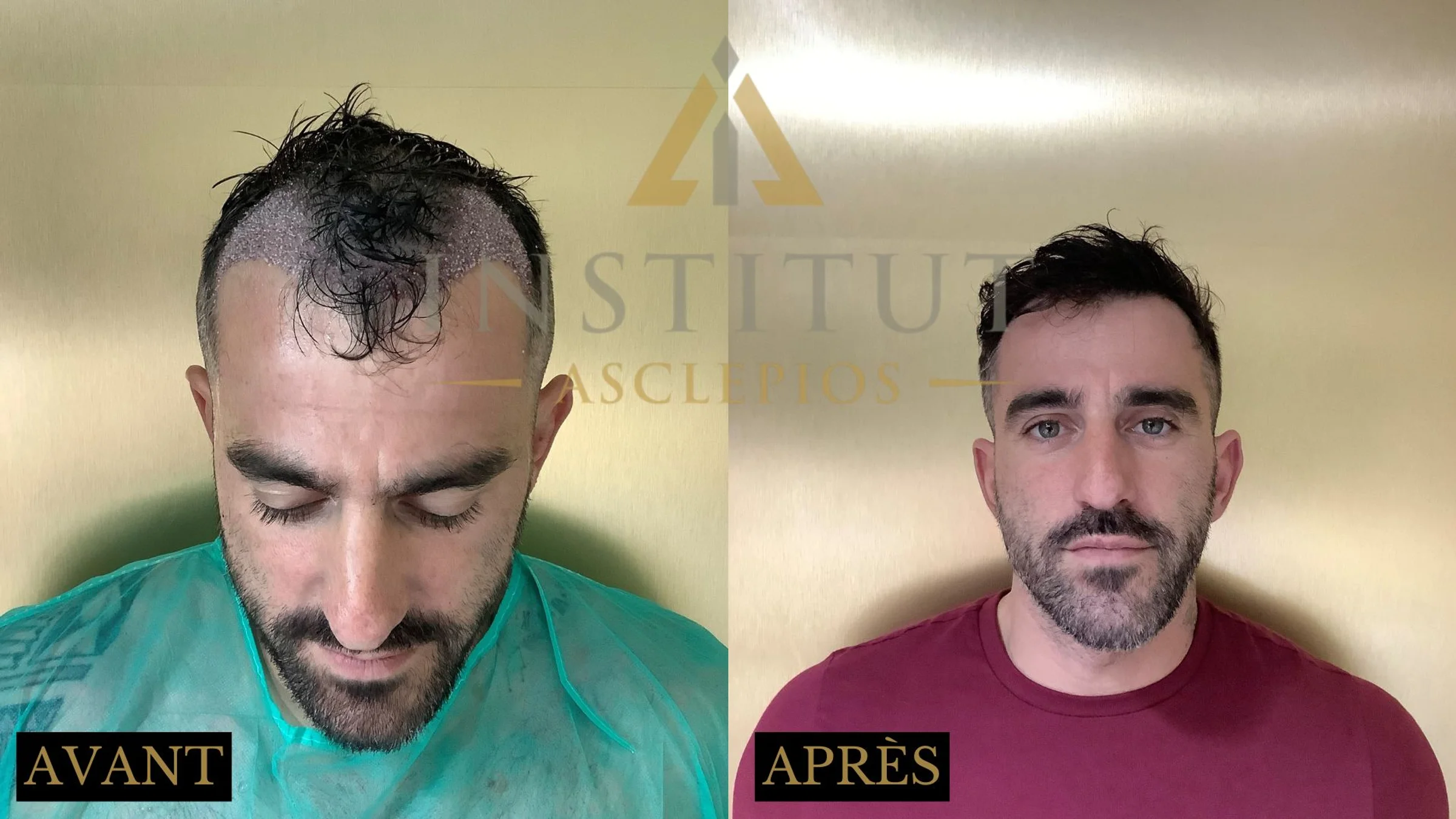 Institut Asclepios, Dr Claude Martin, Strasbourg, France - Gulfs - FUE motorized : 1800