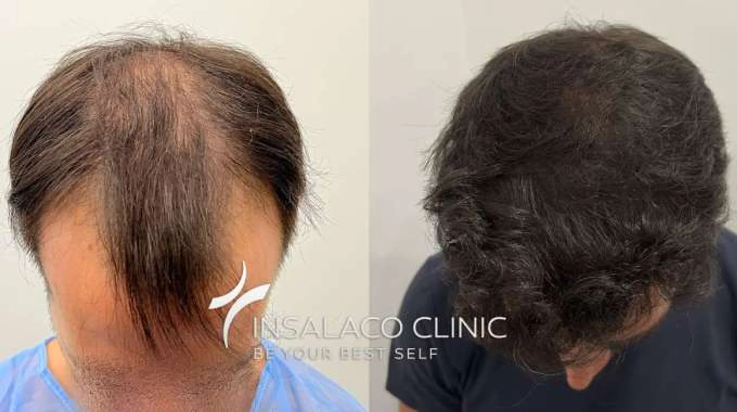 Insalaco clinic, Rome, Italy - Gulfs, Frontal area, Midscalp / Top - FUE motorized, FUE unshaven : 2650