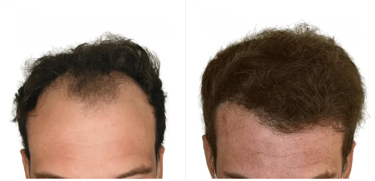 LHR Clinic, Lisbon, Portugal - Frontal area - FUE motorized, Direct FUE (DHI) : 3108