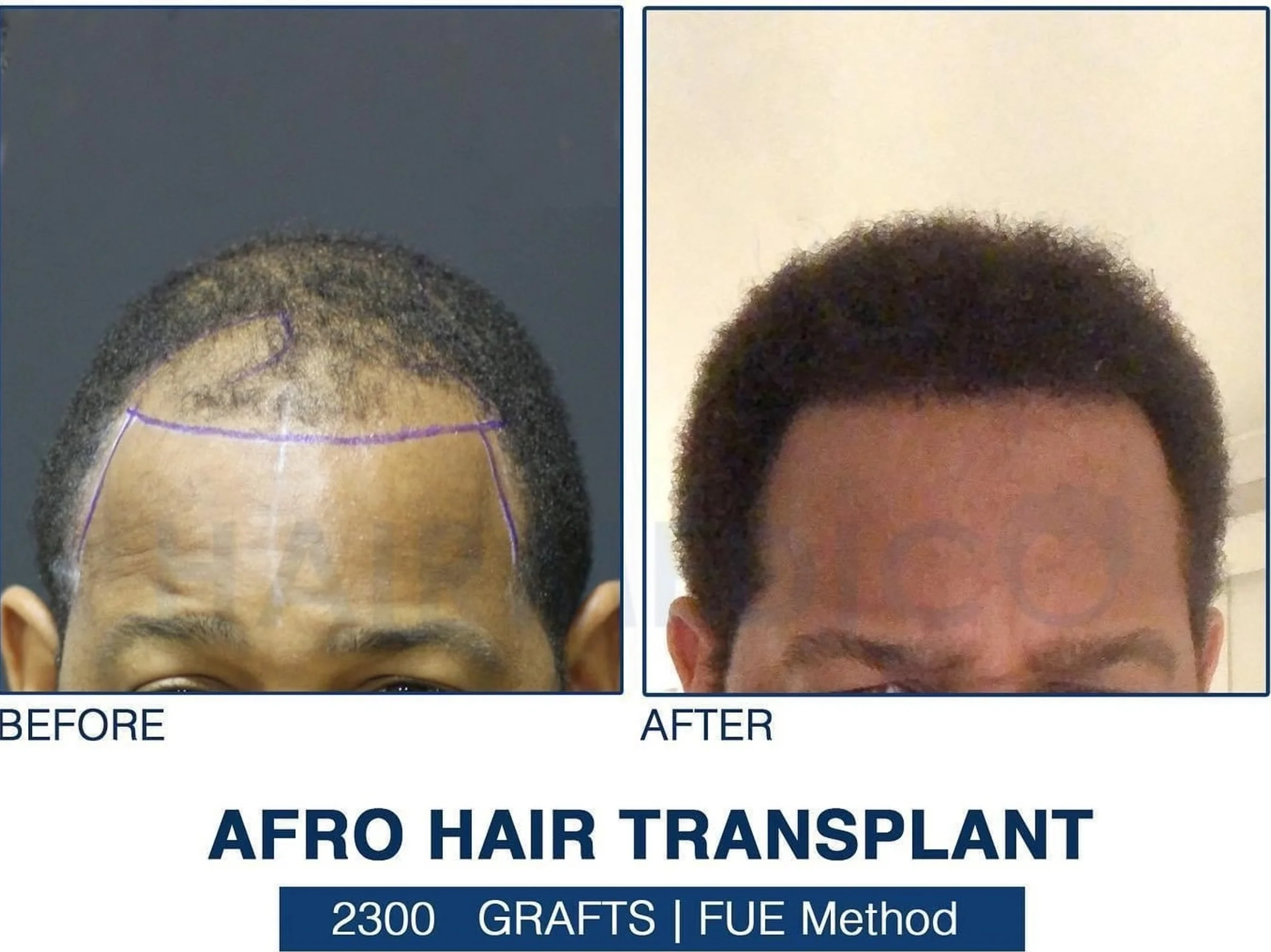 Dr Arslan, HAIRMEDICO, Istanbul, Turkey - Frontal area - FUE motorized : 2300