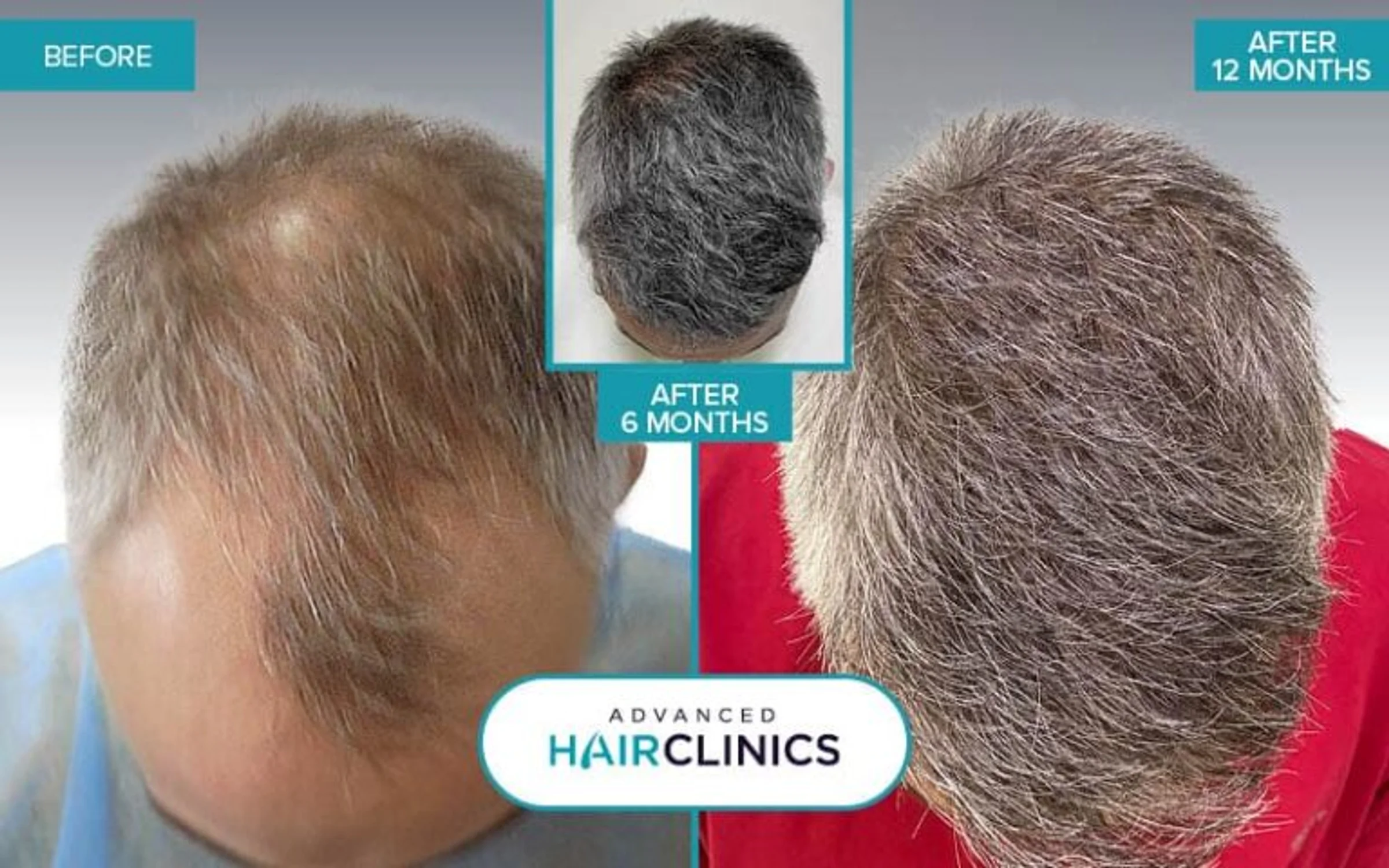 Advanced Hair Clinics, Athens, Greece - Gulfs, Frontal area, Midscalp / Top - Direct FUE (DHI) : 4407