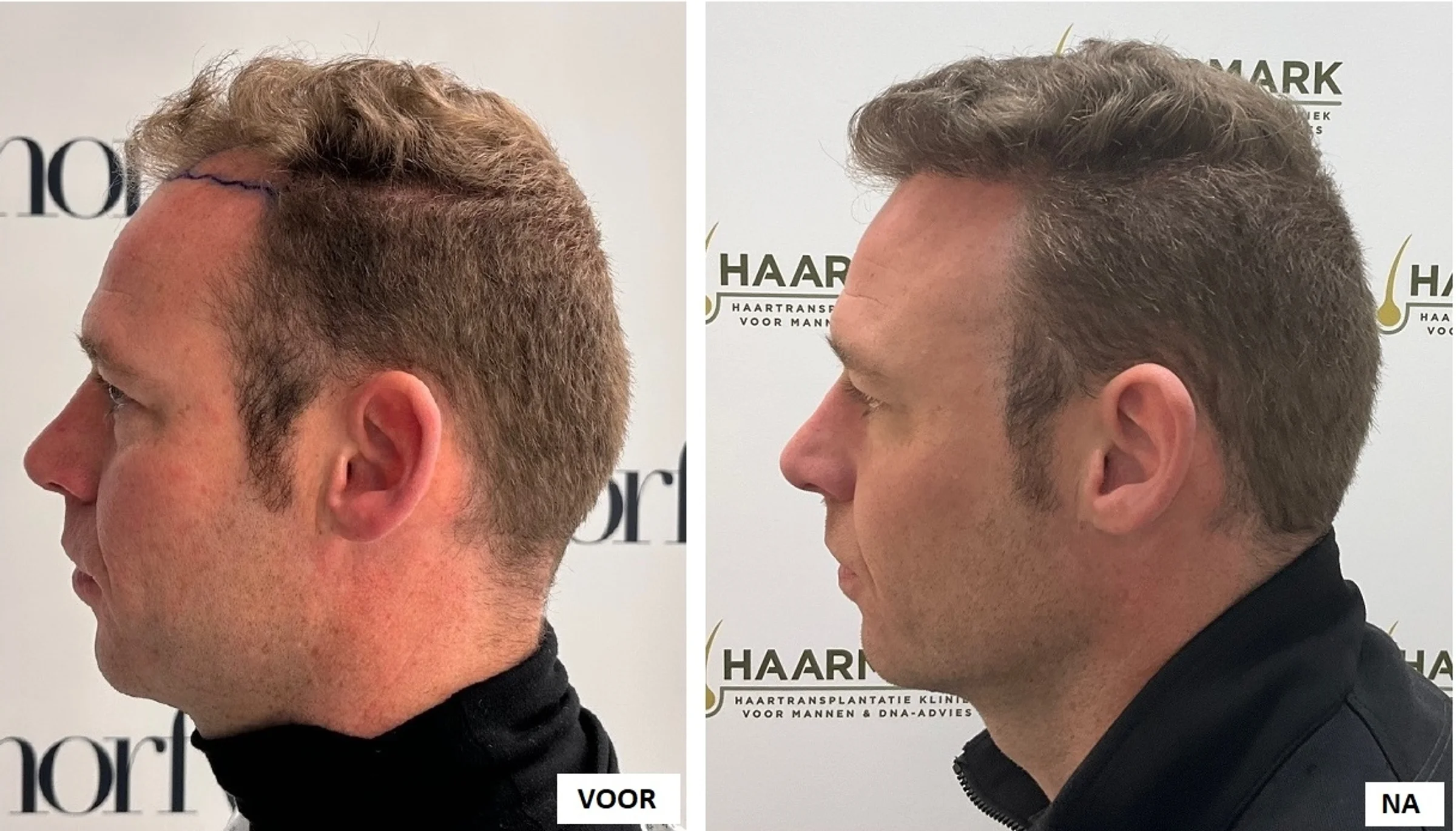 Dr Mark van Bracht, Drachten, The Netherlands - Frontal area - FUE motorized : 2800