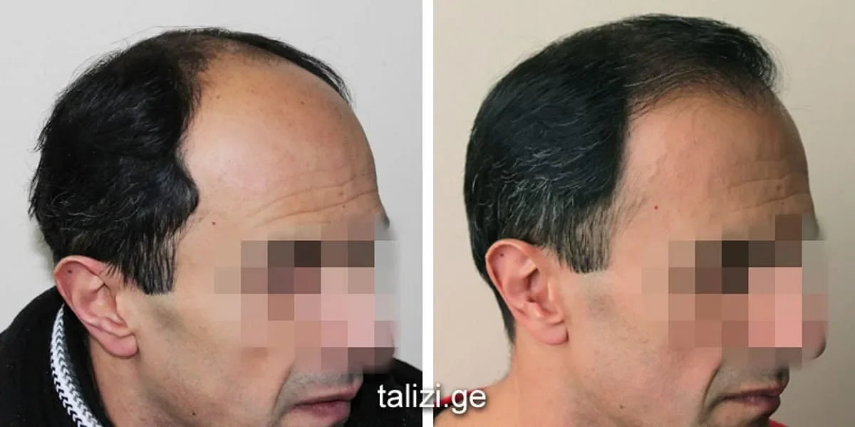 Talizi Clinic, Tbilisi, Georgia - Frontal area - FUE motorized : 2000