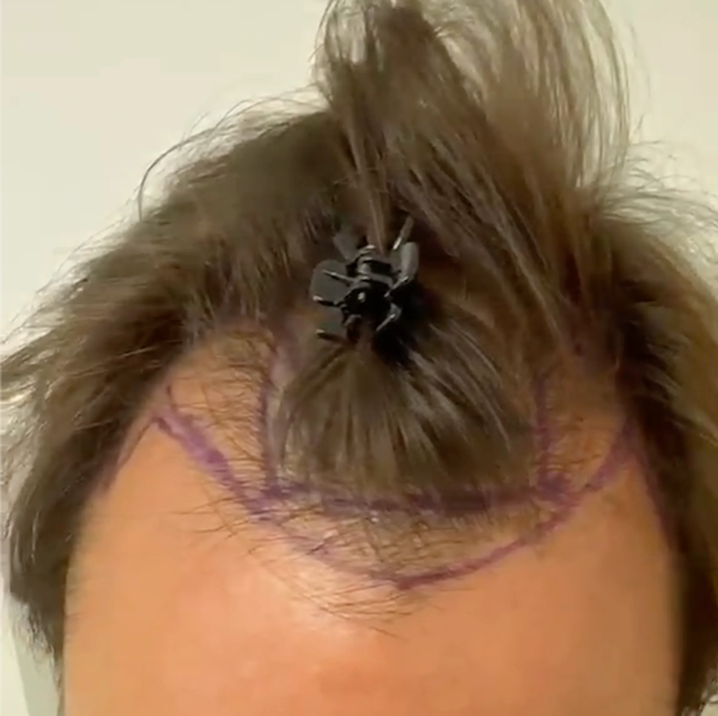 Dr Sabatier, Hexagone clinic, Nice, France - Gulfs - FUE long hair : 2200