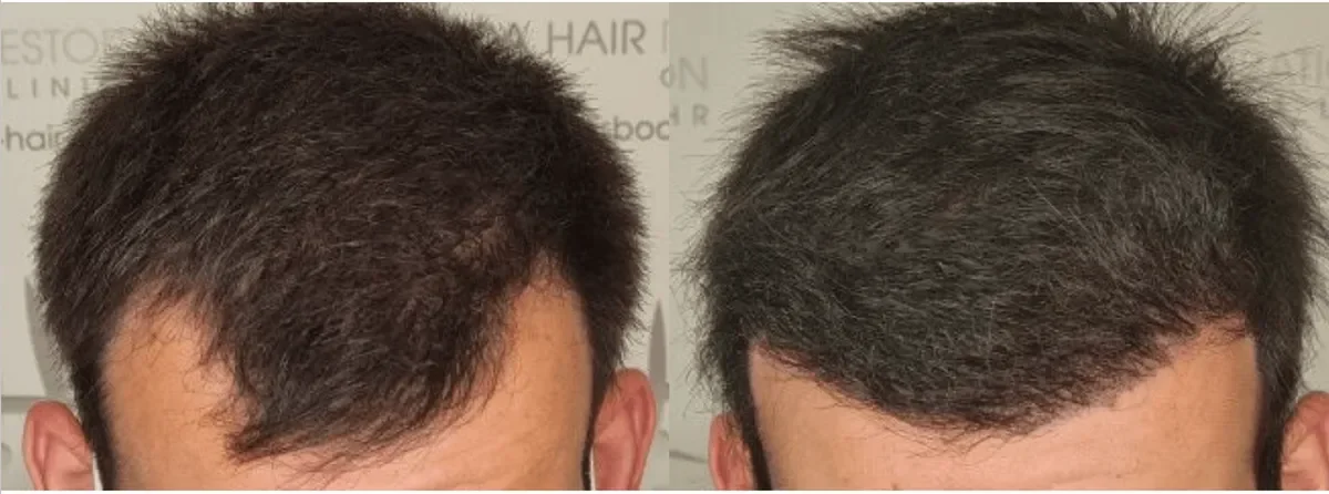 LHR Clinic, Lisbon, Portugal - Frontal area - FUE motorized, Direct FUE (DHI) : 2393