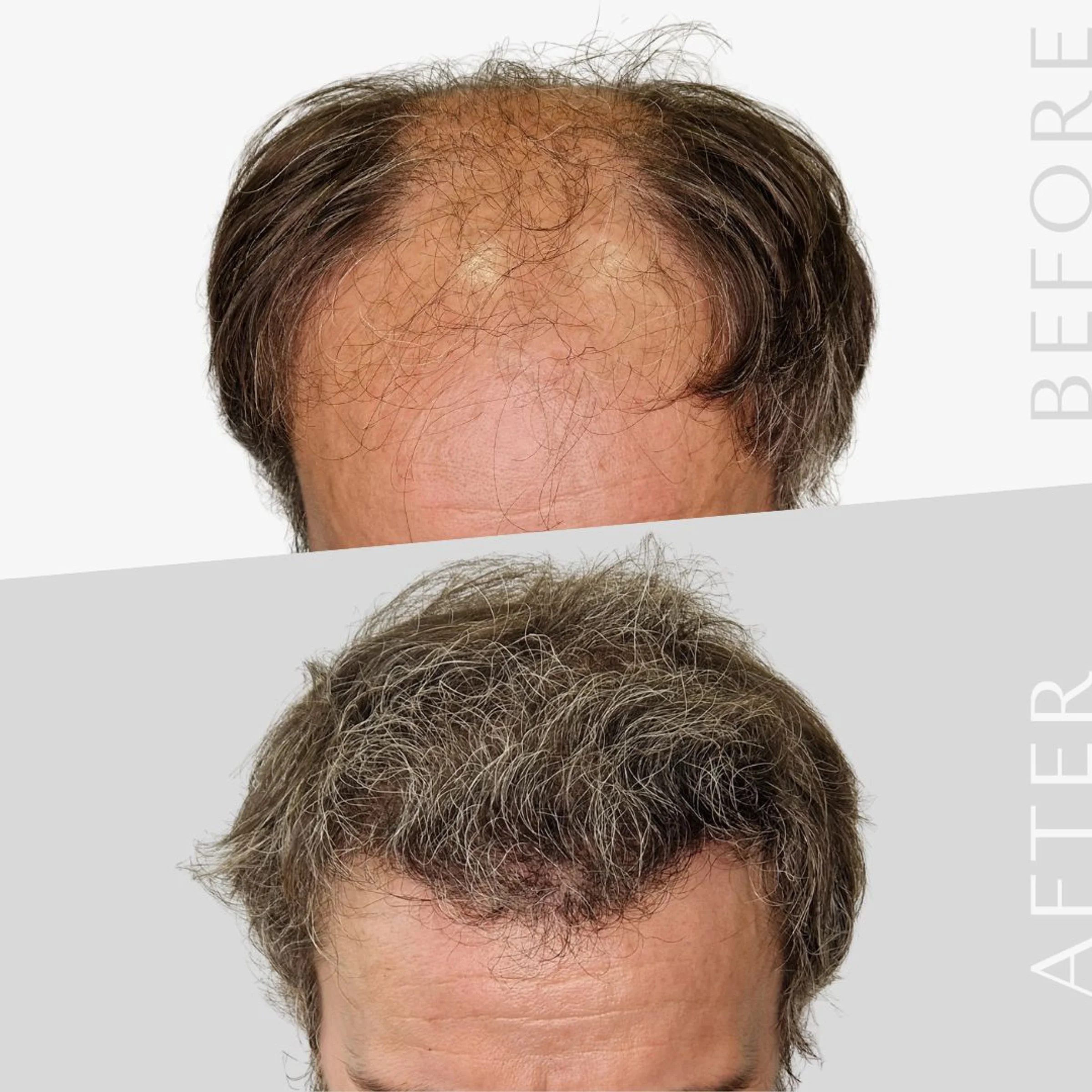 LHR Clinic, Lisbon, Portugal - Extensive Hair Loss - FUE motorized, Direct FUE (DHI) : 4920