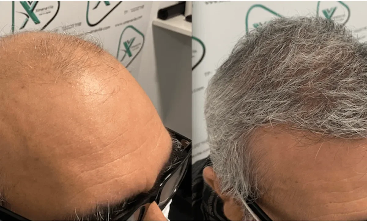 Dra Ximena Vila, Madrid, Spain - Extensive Hair Loss - FUE manual, Direct FUE (DHI) : 5602