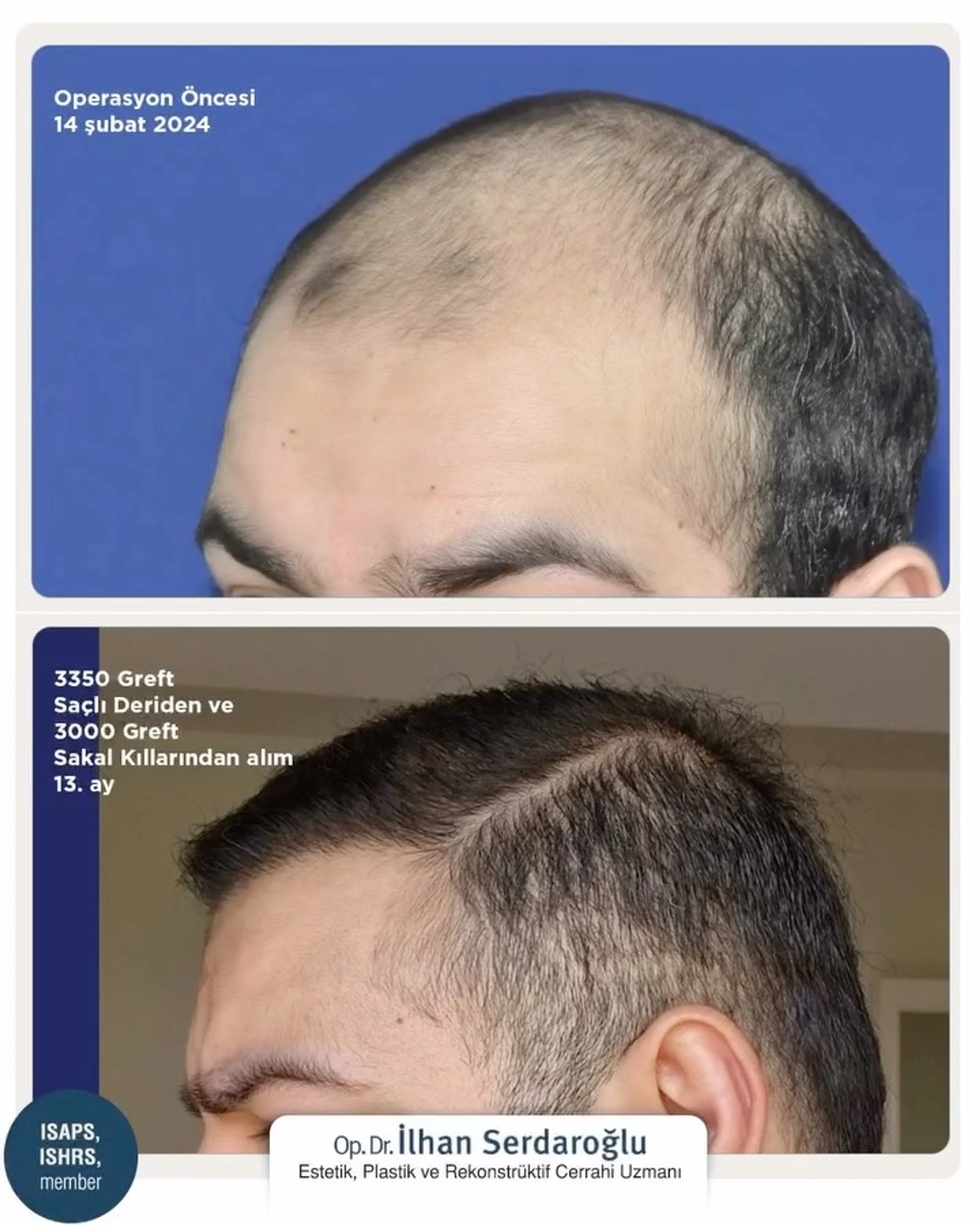 Dr Ilhan Serdaroglu, Istanbul, Turkey - Frontal area, Midscalp / Top - FUE motorized : 3350