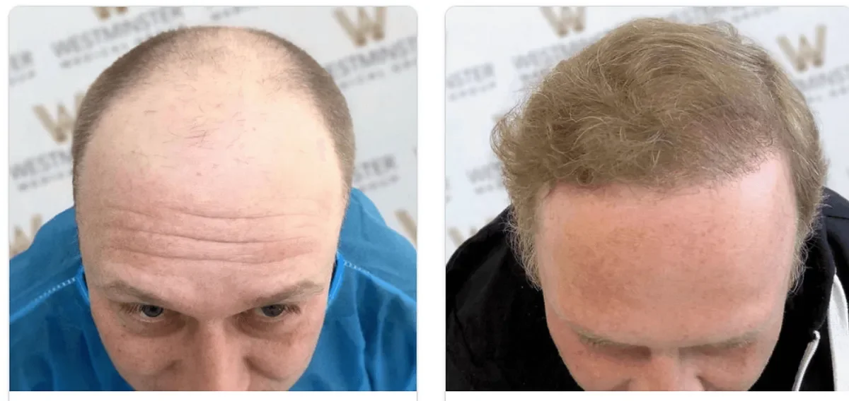 Westminster Medical Group, London, United Kingdom - Extensive Hair Loss - FUT, FUE motorized : 4692