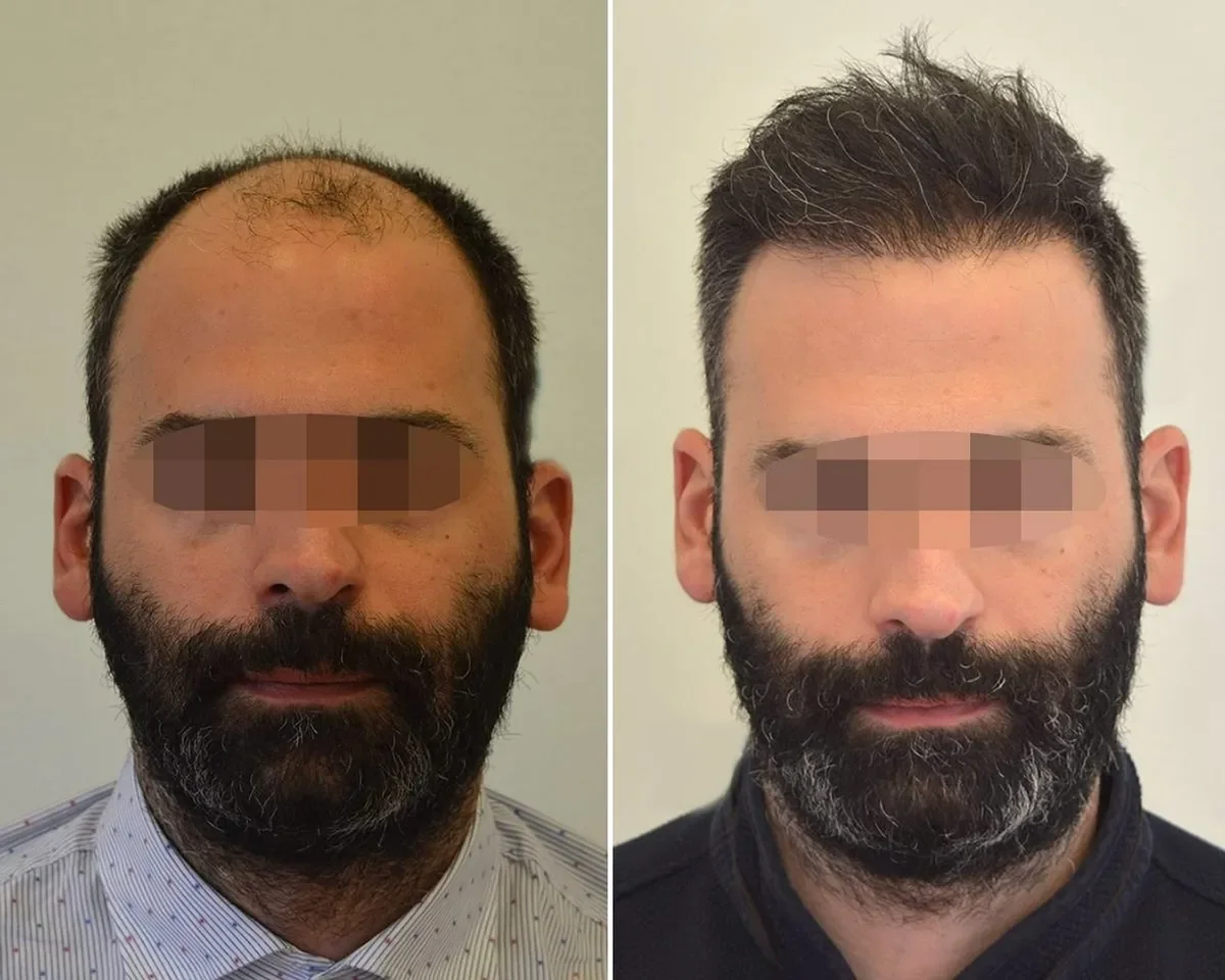 Seneca Medical Group, Greece - Extensive Hair Loss, Frontal area - FUE motorized, Direct FUE (DHI) : 2830