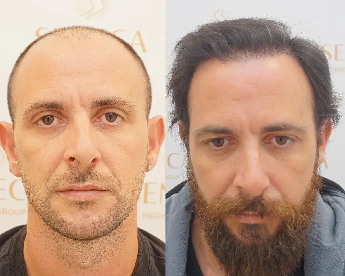 Seneca Medical Group, Greece - Extensive Hair Loss, Frontal area - FUE motorized, Direct FUE (DHI) : 3612