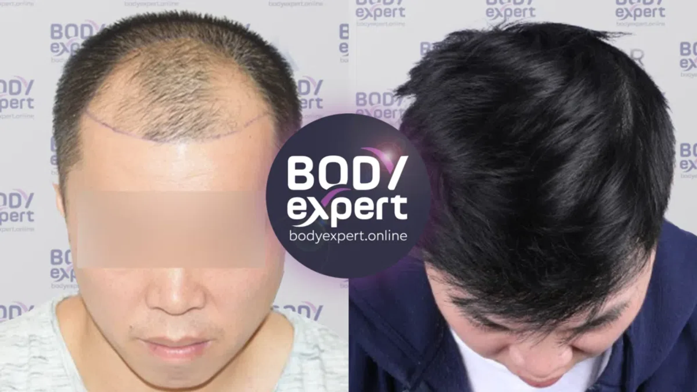 Body Expert, Orion clinic, Istanbul, Turkey - Frontal area - FUE motorized : 3500