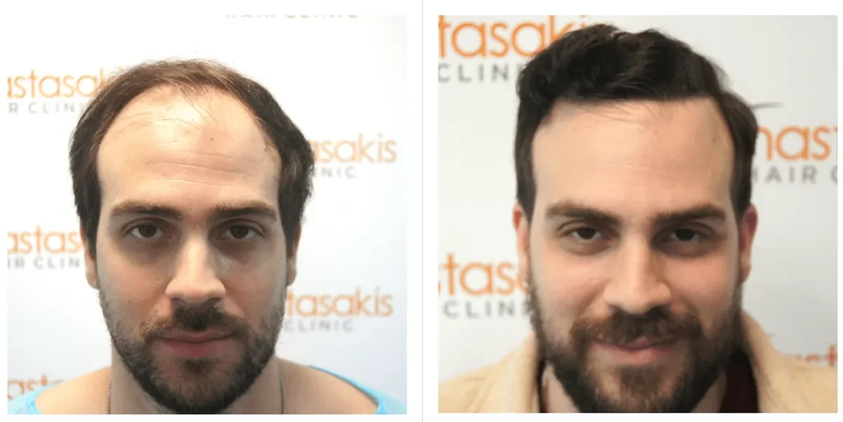 Anastasakis Hair Clinic, Athens, Greece - Frontal area - FUE motorized : 3500