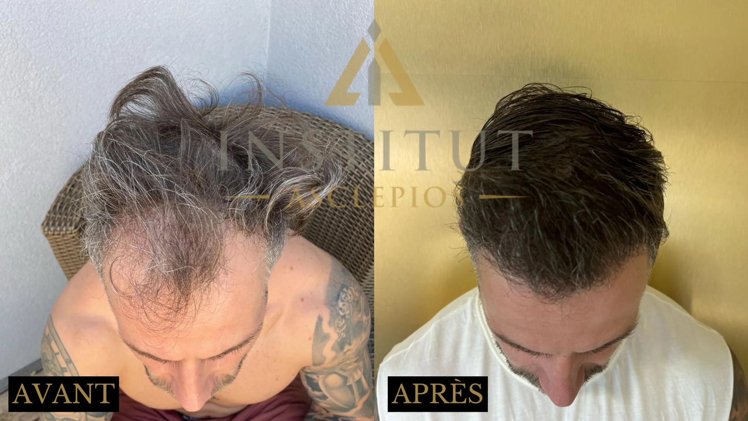 Institut Asclepios, Dr Claude Martin, Strasbourg, France - Frontal area, Midscalp / Top - FUE motorized : 2700