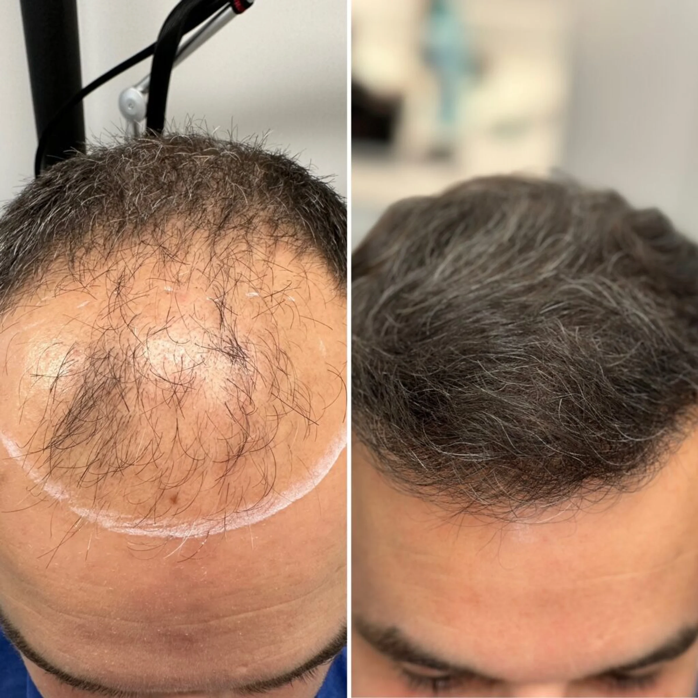 Centre des Canuts, Lyon, France - Frontal area, Midscalp / Top - FUE motorized : 2600