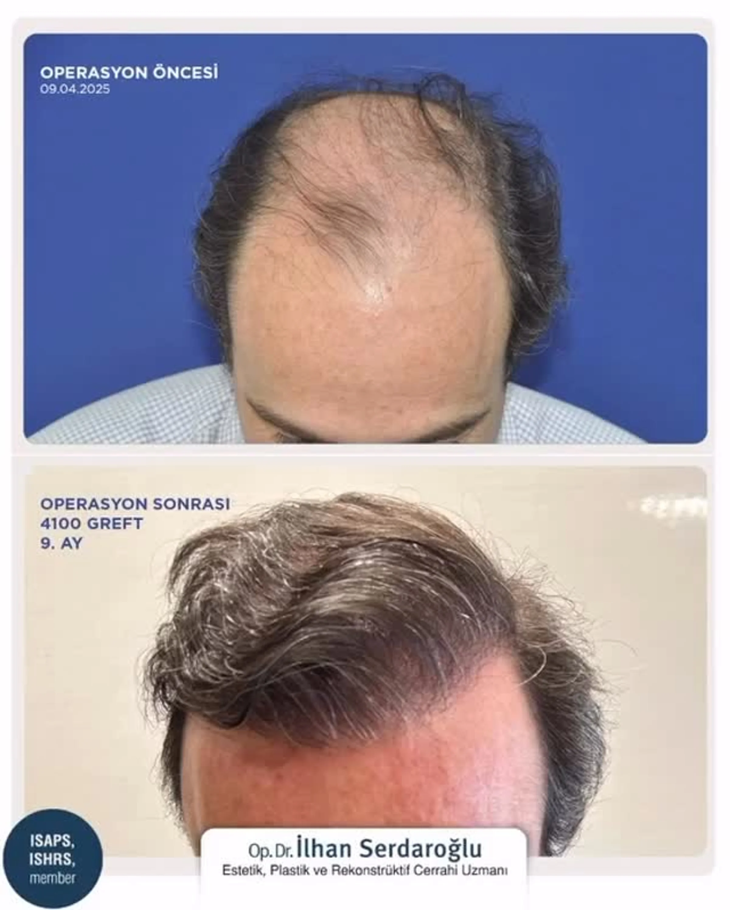 Dr Ilhan Serdaroglu, Istanbul, Turkey - Extensive Hair Loss, Midscalp / Top - FUE motorized : 4100