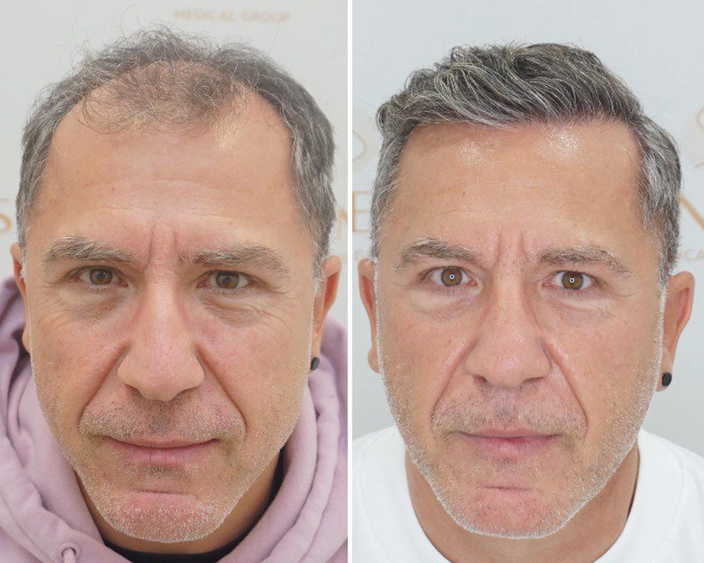 Seneca Medical Group, Greece - Gulfs, Frontal area - FUE motorized, Direct FUE (DHI) : 2720