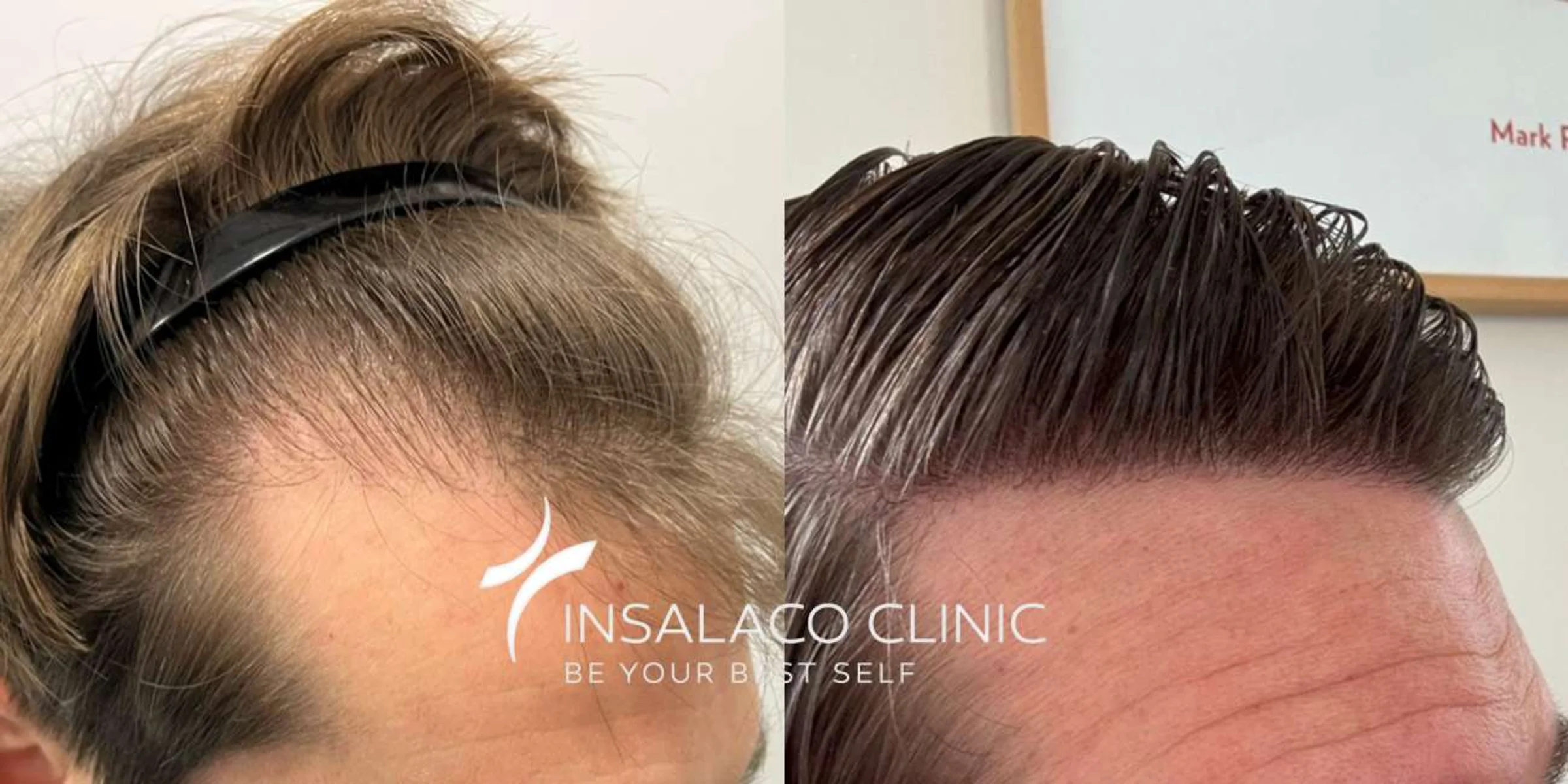 Insalaco clinic, Rome, Italy - Gulfs, Frontal area - FUE motorized, FUE long hair : 1600