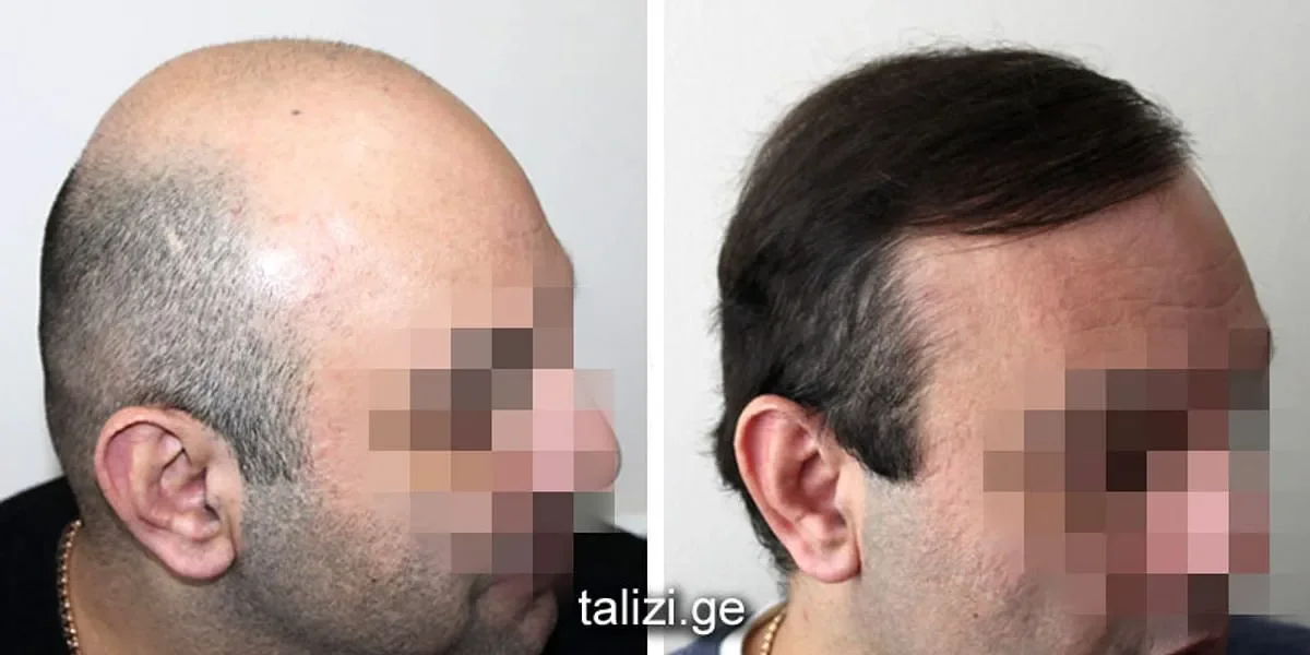 Talizi Clinic, Tbilisi, Georgia - Extensive Hair Loss - FUE motorized : 4000