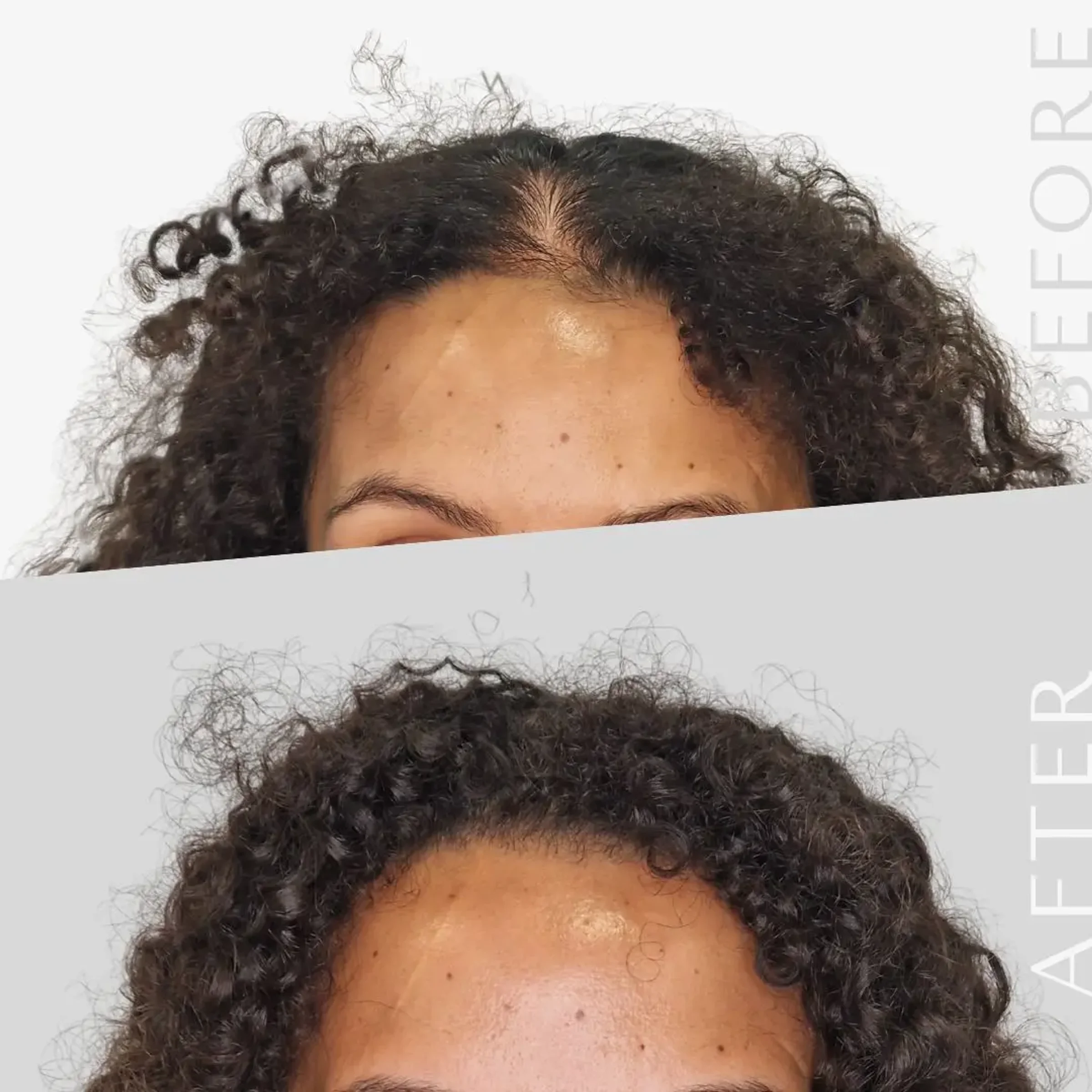 LHR Clinic, Lisbon, Portugal - Frontal area, Thinning hair - FUE motorized, Direct FUE (DHI) : 2450