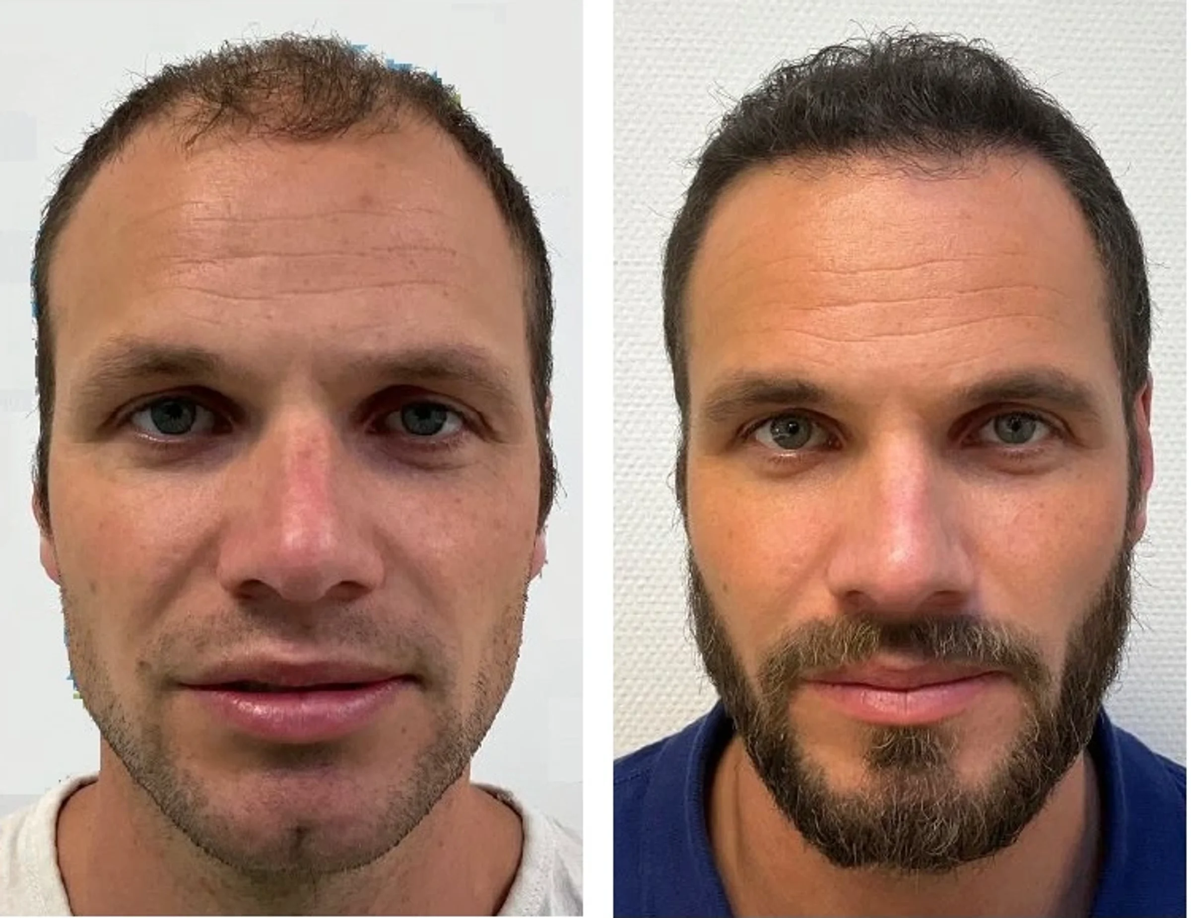 Dr Mark van Bracht, Drachten, The Netherlands - Frontal area - FUE motorized : 1300