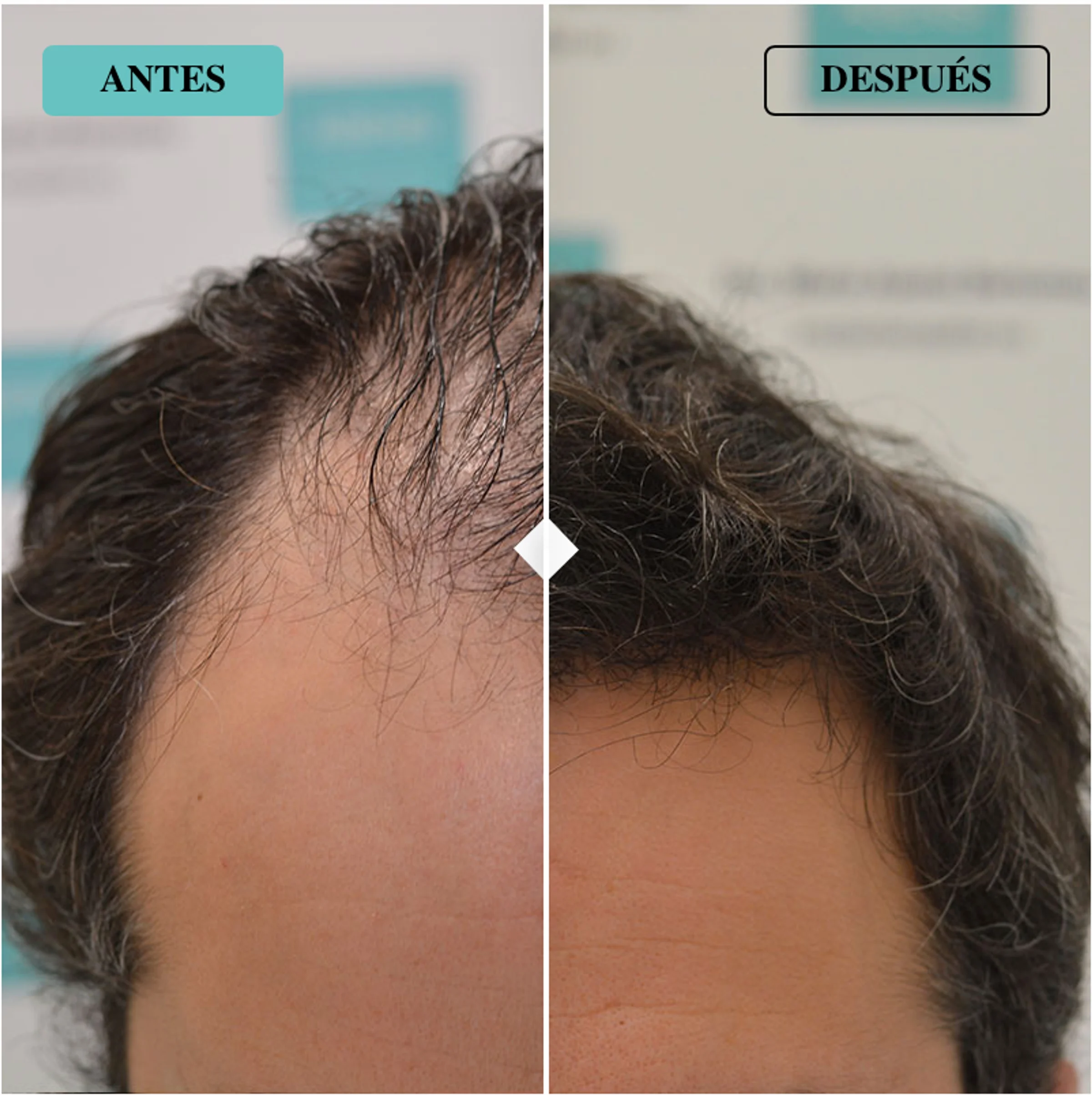 Dr Maria Asensi, Palma de Mallorca, Spain - Gulfs, Frontal area - FUE motorized, Direct FUE (DHI) : 