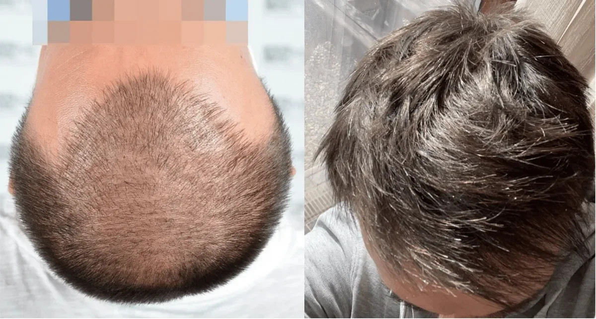 ASMED, Istanbul, Turkey - Frontal area, Crown / Vertex - FUE manual : 4541