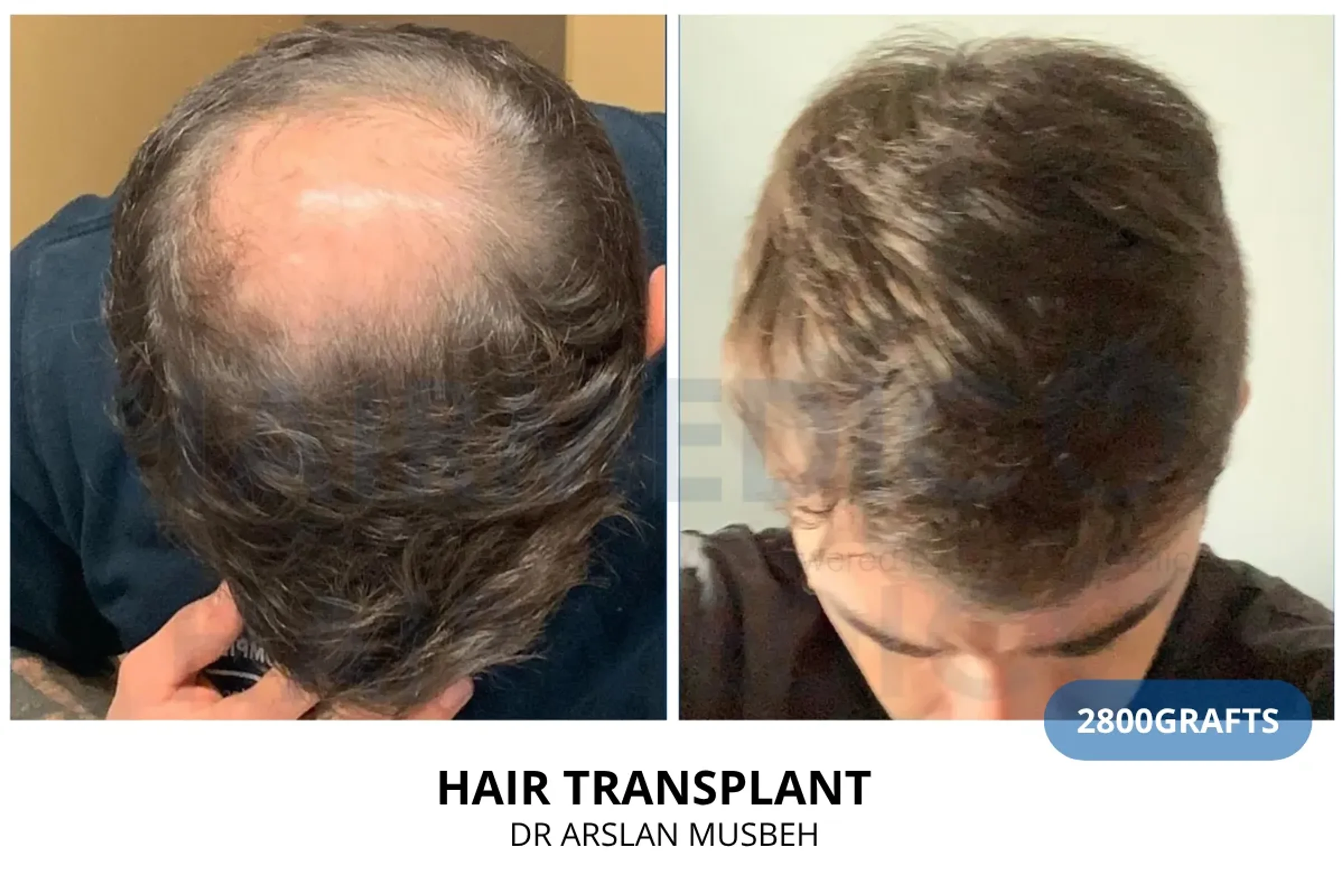 Dr Arslan, HAIRMEDICO, Istanbul, Turkey - Crown / Vertex, Midscalp / Top - FUE motorized : 2800