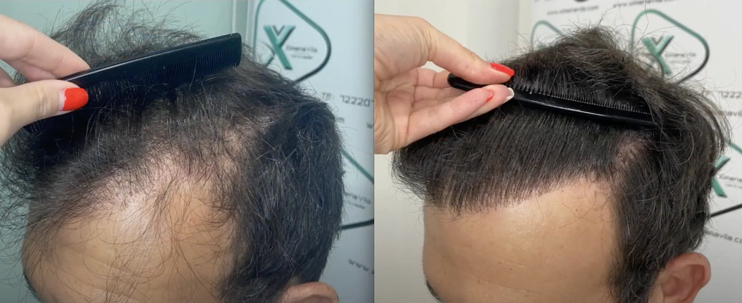 Dra Ximena Vila, Madrid, Spain - Gulfs, Frontal area - FUE manual, Direct FUE (DHI) : 2552