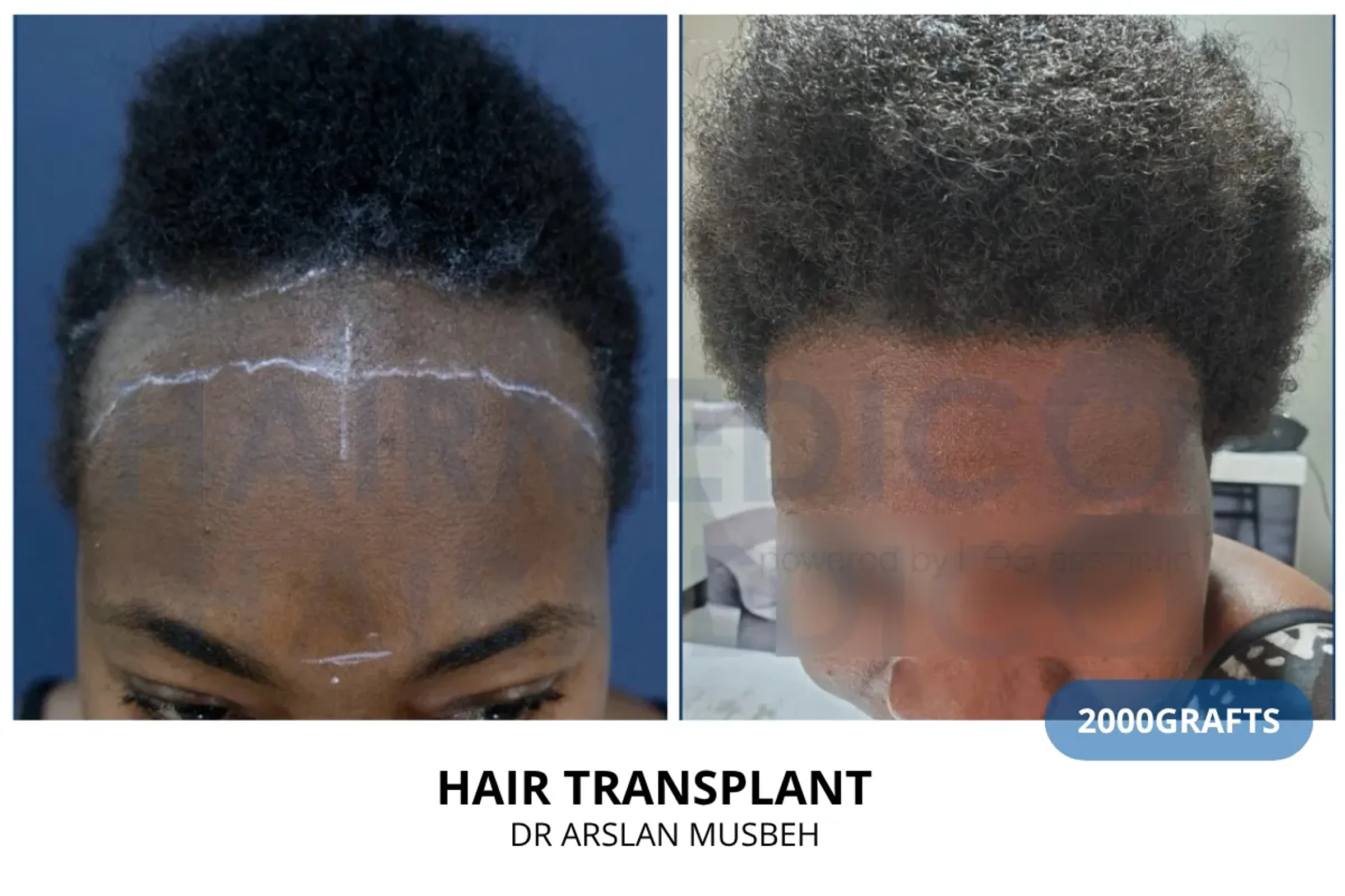 Dr Arslan, HAIRMEDICO, Istanbul, Turkey - Frontal area - FUE motorized : 2000