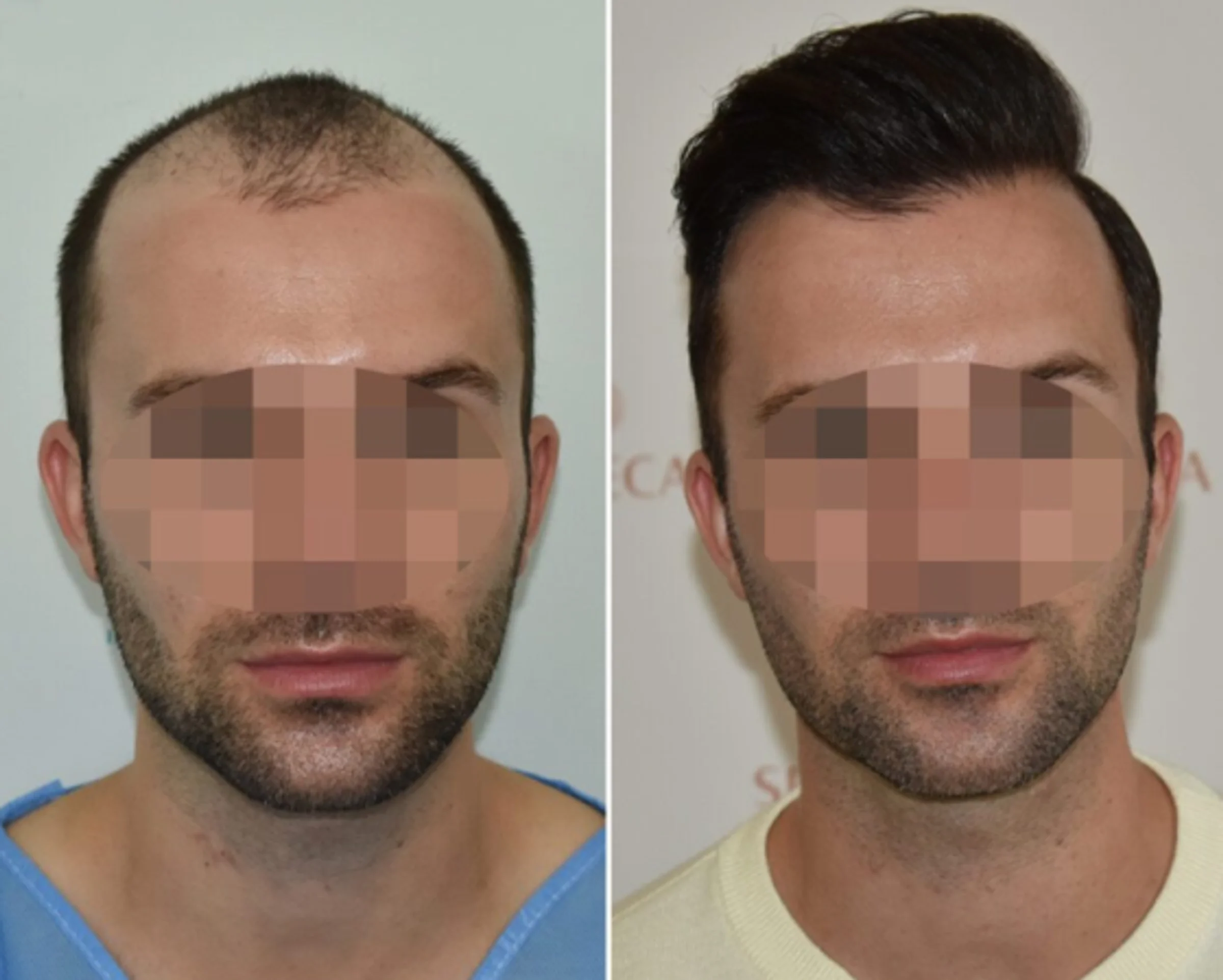 Seneca Medical Group, Greece - Frontal area, Midscalp / Top - FUE motorized, Direct FUE (DHI) : 2660
