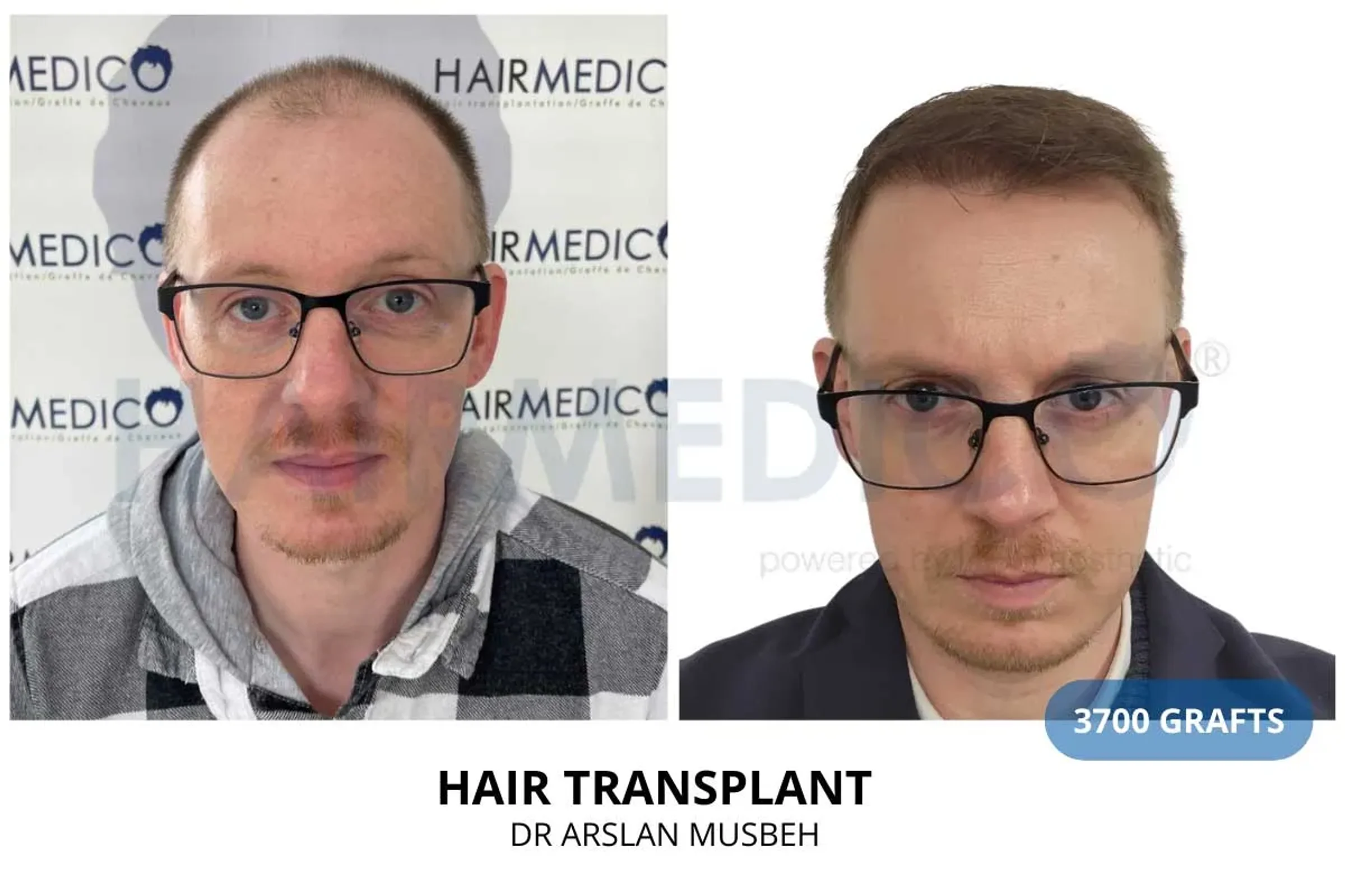 Dr Arslan, HAIRMEDICO, Istanbul, Turkey - Frontal area, Midscalp / Top - FUE motorized : 3700