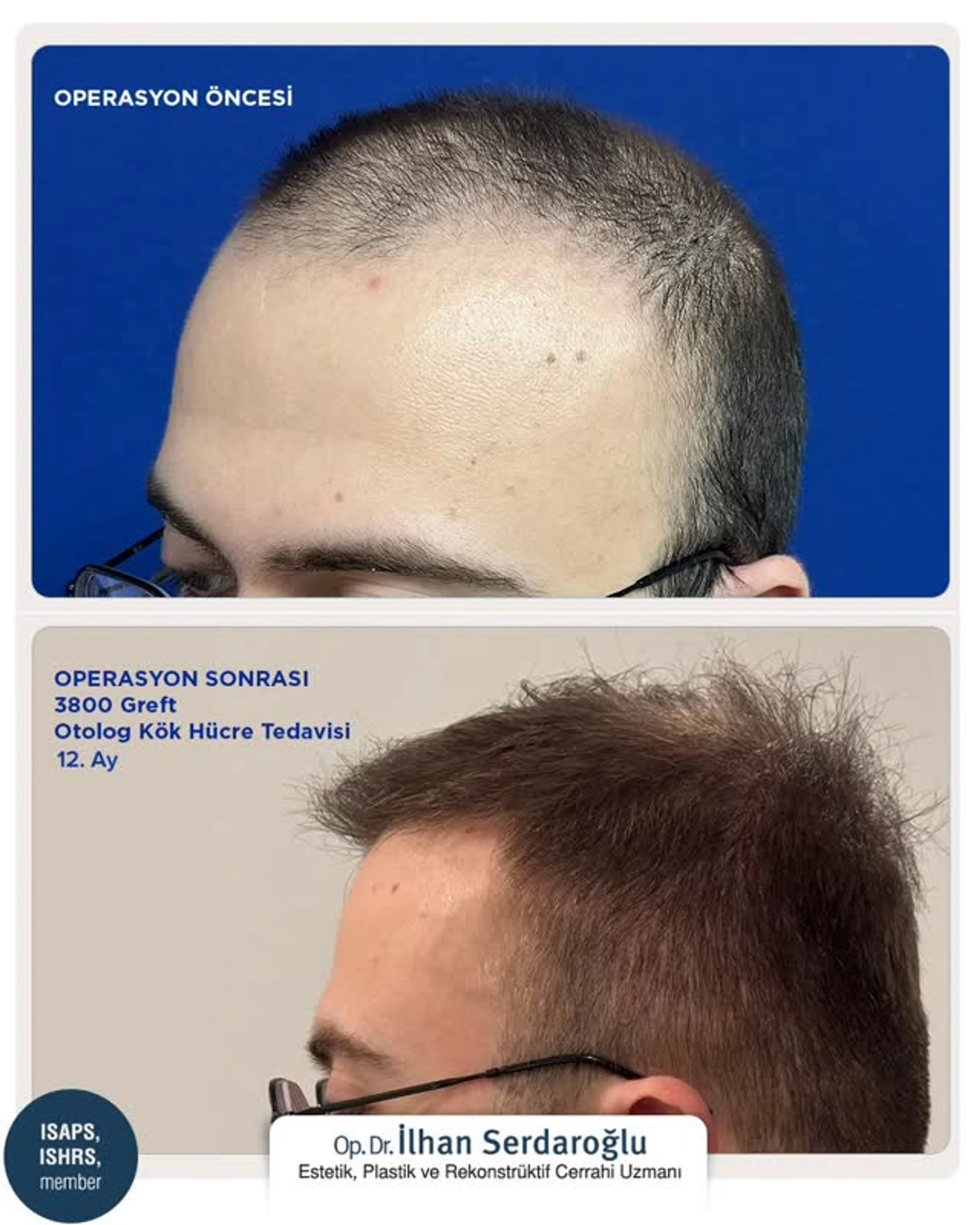 Dr Ilhan Serdaroglu, Istanbul, Turkey - Frontal area - FUE motorized : 3800