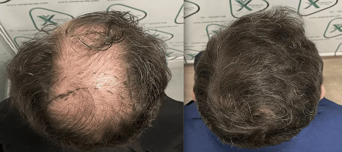 Dra Ximena Vila, Madrid, Spain - Extensive Hair Loss - FUE manual, Direct FUE (DHI) : 3423