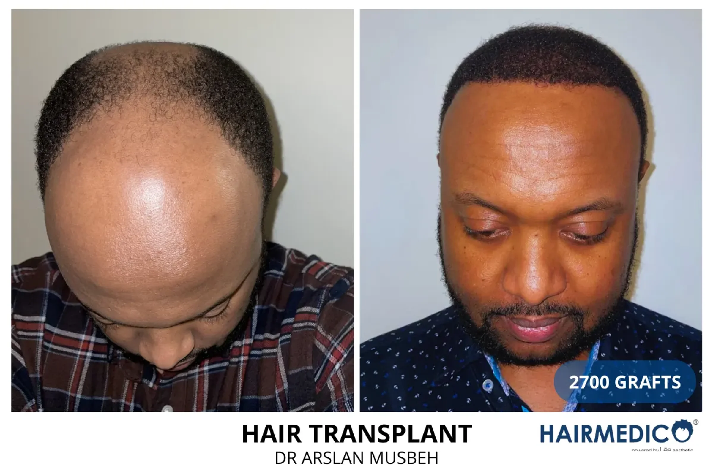 Dr Arslan, HAIRMEDICO, Istanbul, Turkey - Frontal area - FUE motorized : 2700