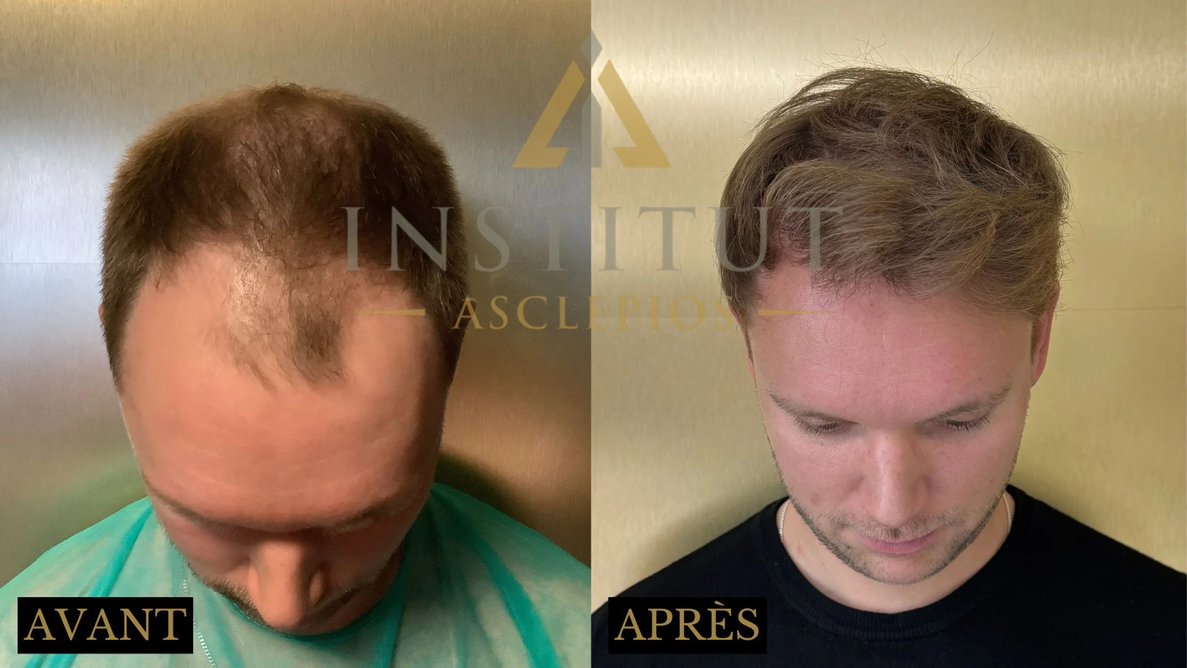 Institut Asclepios, Dr Claude Martin, Strasbourg, France - Frontal area, Midscalp / Top, Thinning hair - FUE motorized : 2800