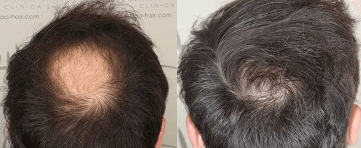 LHR Clinic, Lisbon, Portugal - Crown / Vertex - FUE motorized, Direct FUE (DHI) : 2432