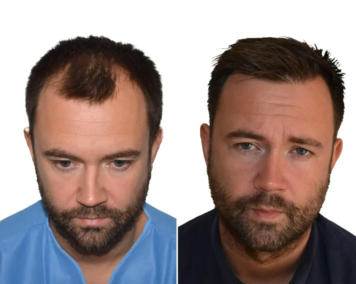 Seneca Medical Group, Greece - Frontal area - FUE motorized, Direct FUE (DHI) : 1450