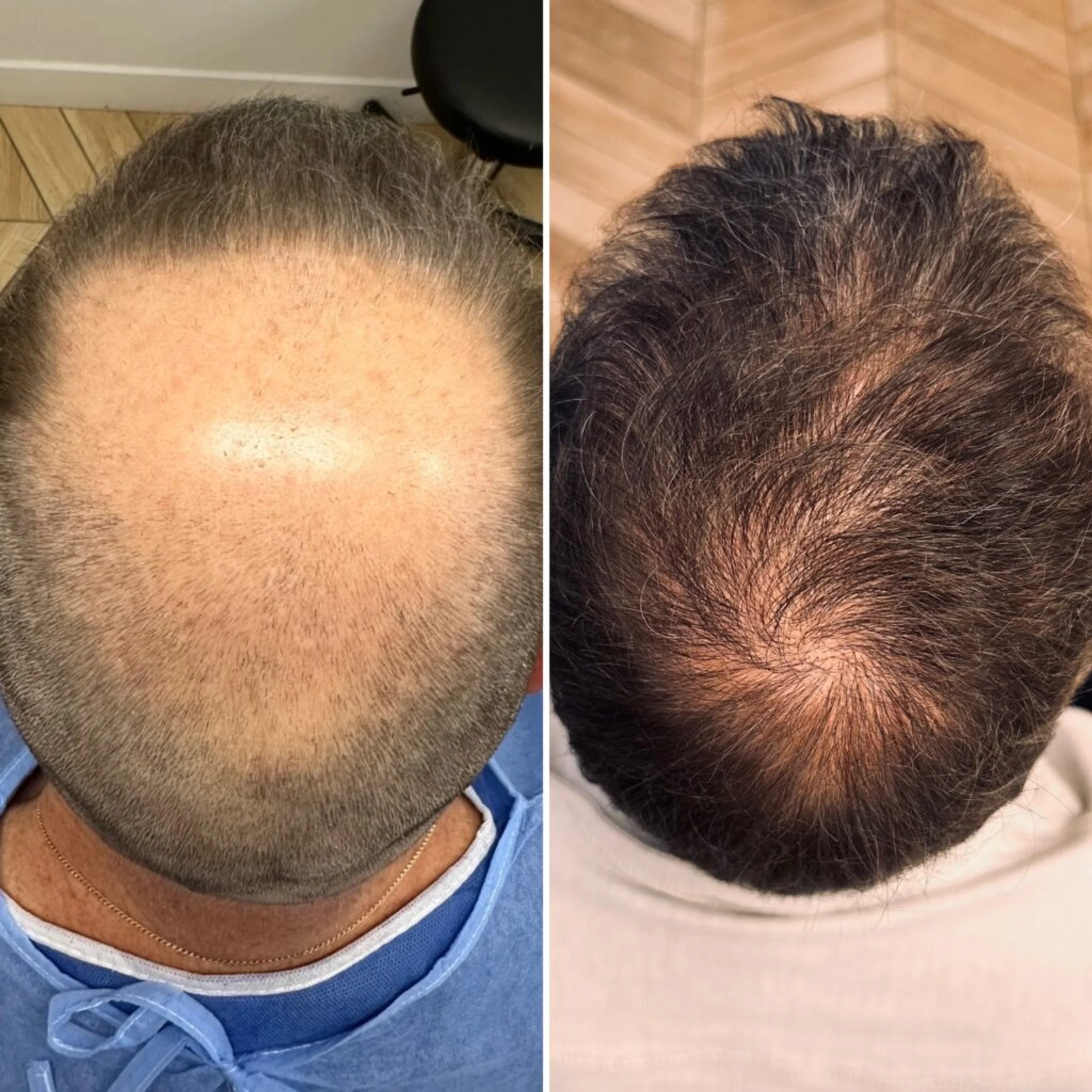 Centre des Canuts, Lyon, France - Crown / Vertex - FUE motorized : 2500