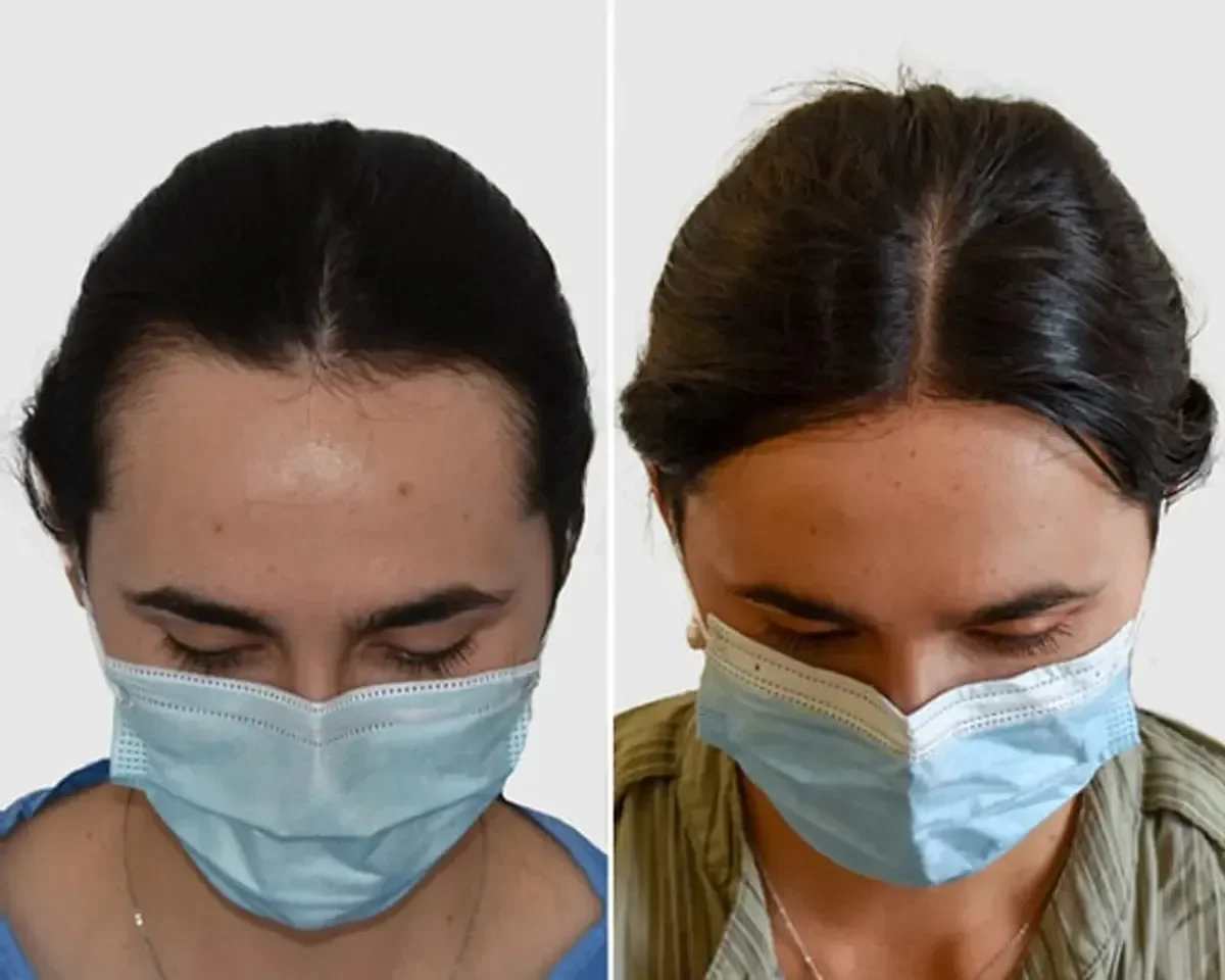 Seneca Medical Group, Greece - Frontal area - FUE motorized, Direct FUE (DHI) : 1116