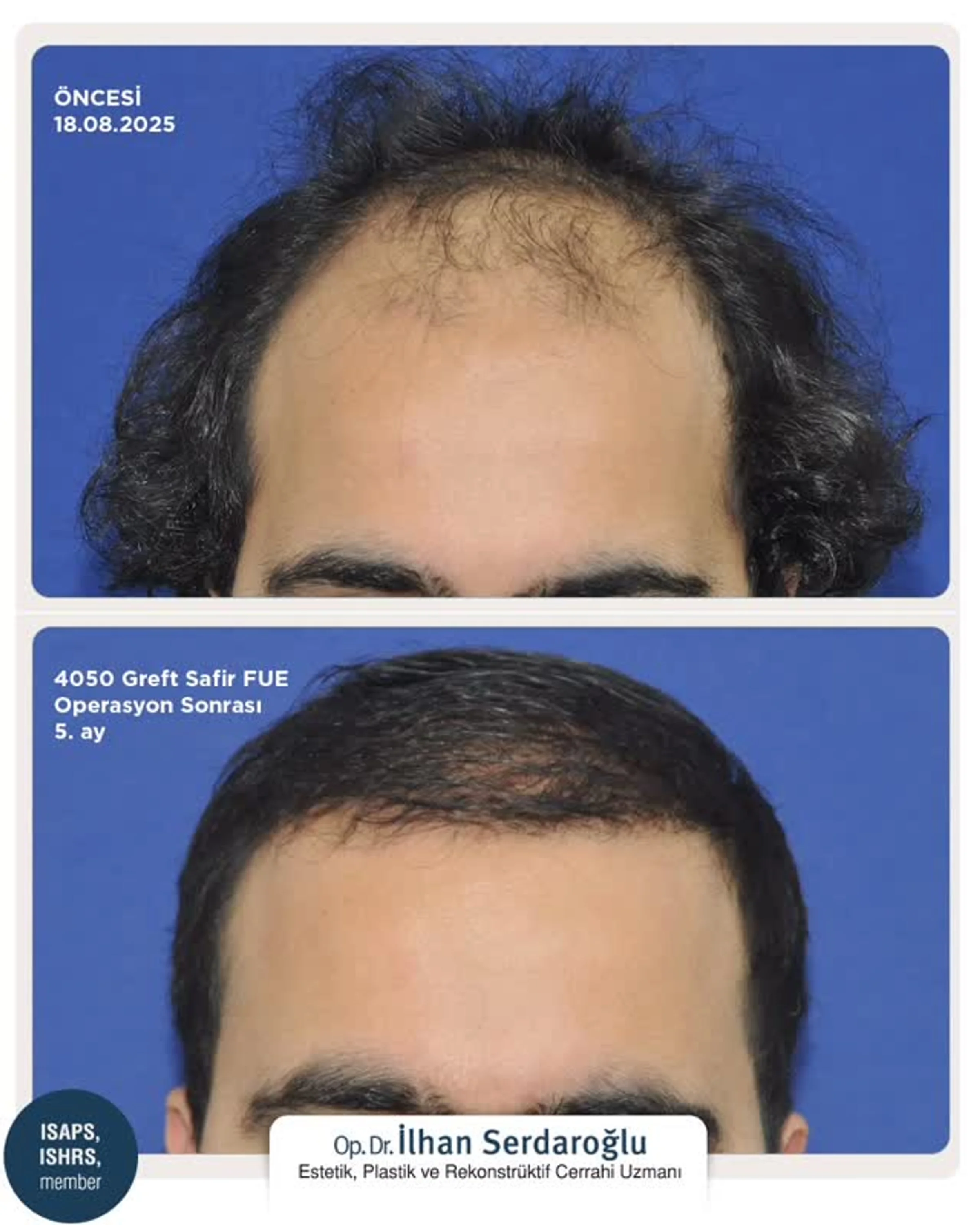 Dr Ilhan Serdaroglu, Istanbul, Turkey - Frontal area - FUE motorized : 4051