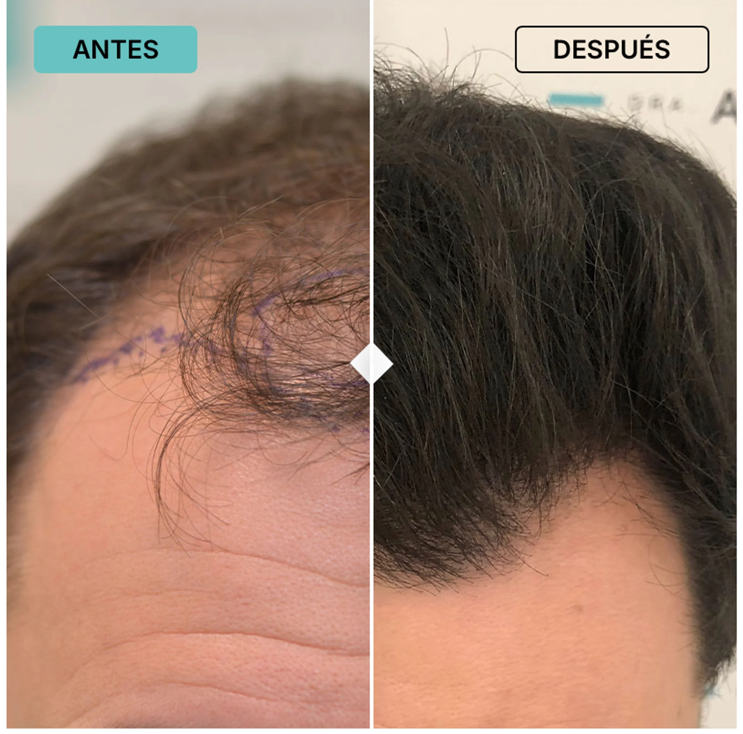 Dr Maria Asensi, Palma de Mallorca, Spain - Frontal area, Gulfs - FUE motorized, Direct FUE (DHI) : 