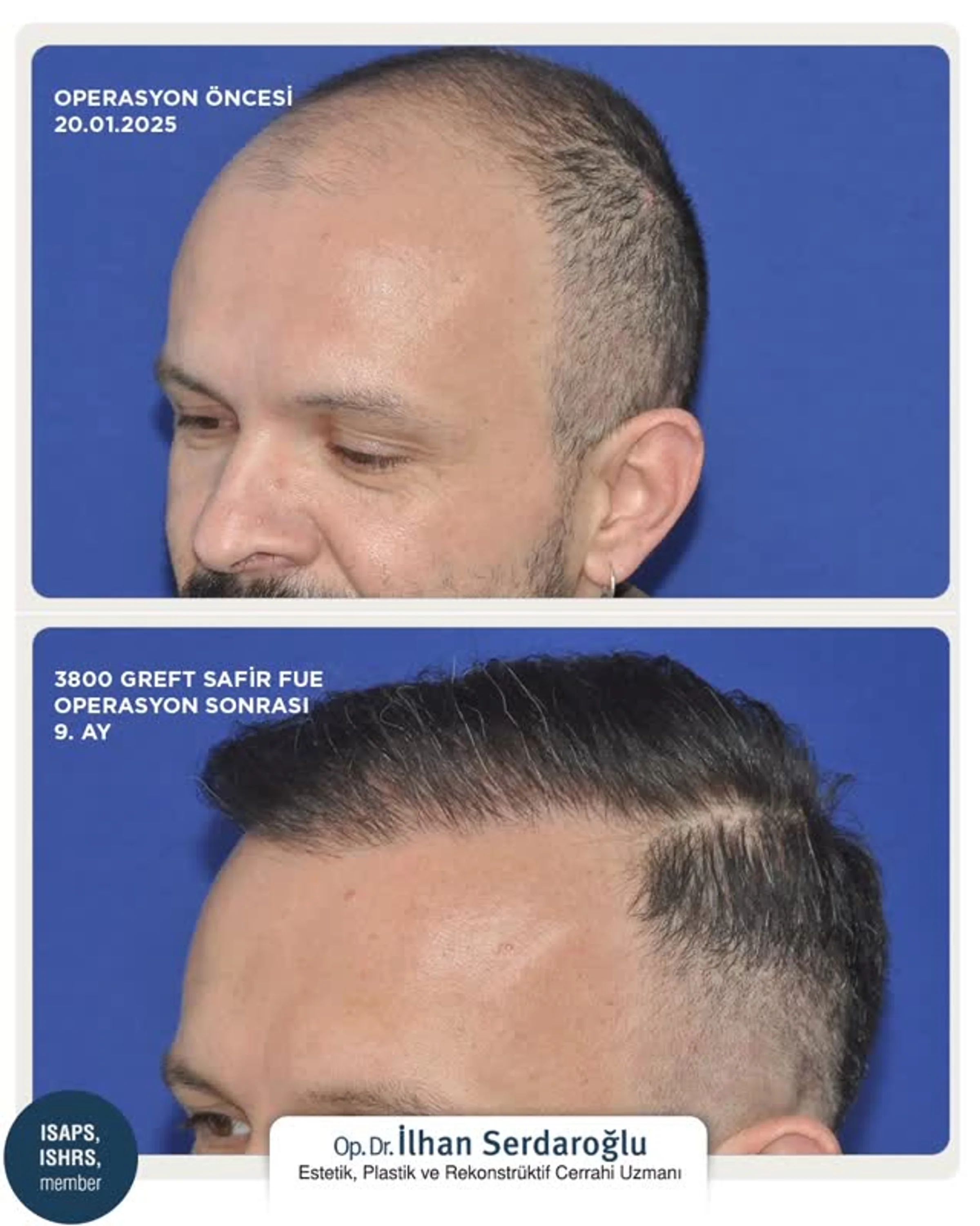 Dr Ilhan Serdaroglu, Istanbul, Turkey - Frontal area - FUE motorized : 3800