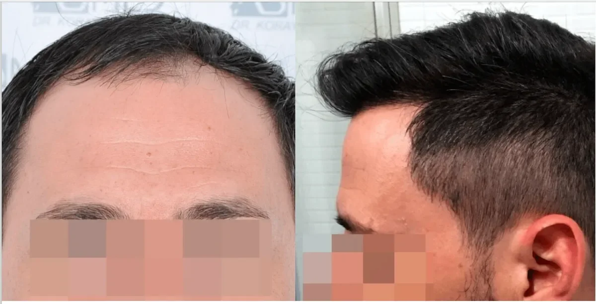 ASMED, Istanbul, Turkey - Frontal area - FUE manual : 3221
