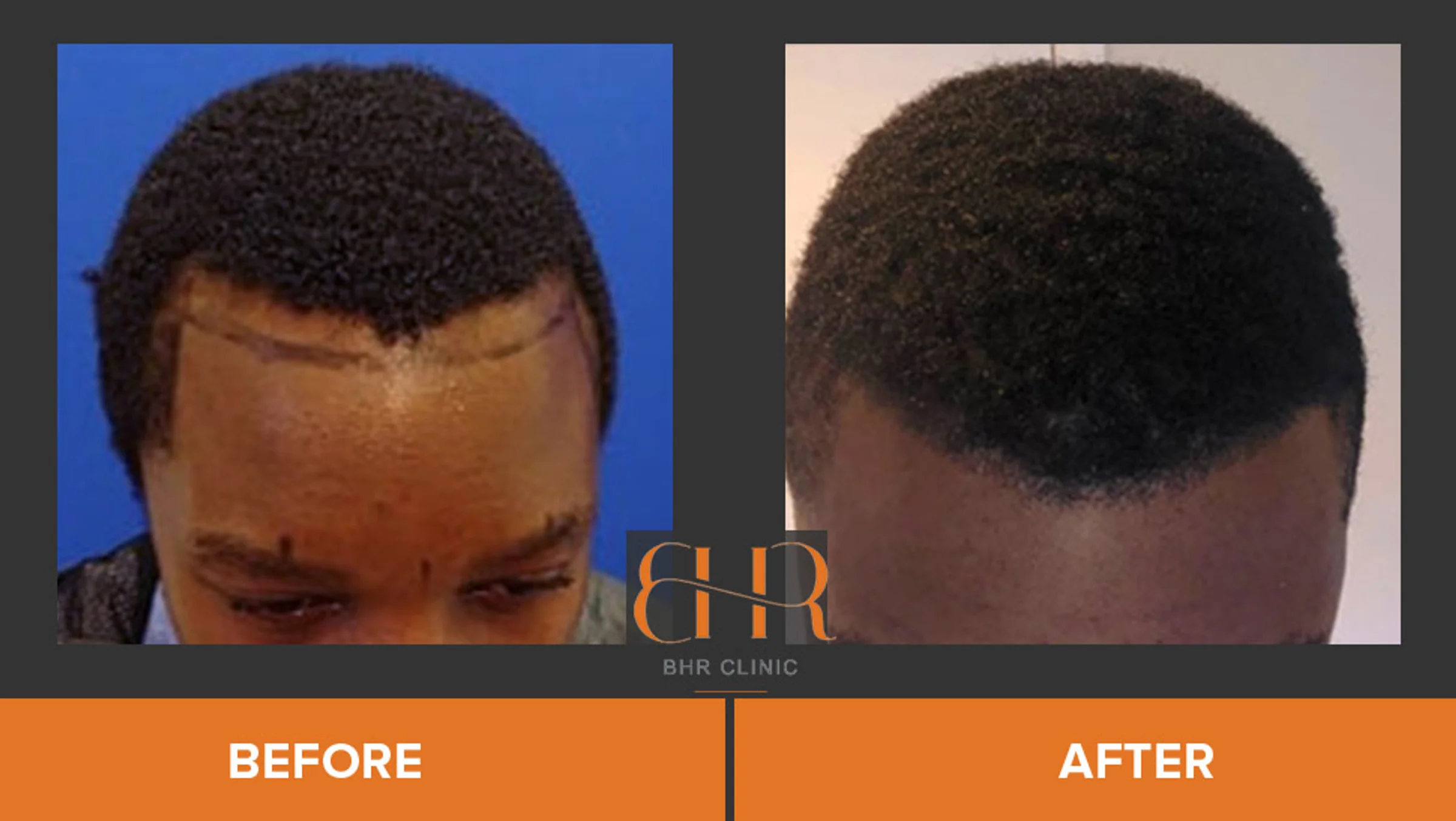 BHR Clinic, Dr Bisanga, Brussels, Belgium - Frontal area - FUE motorized : 2001