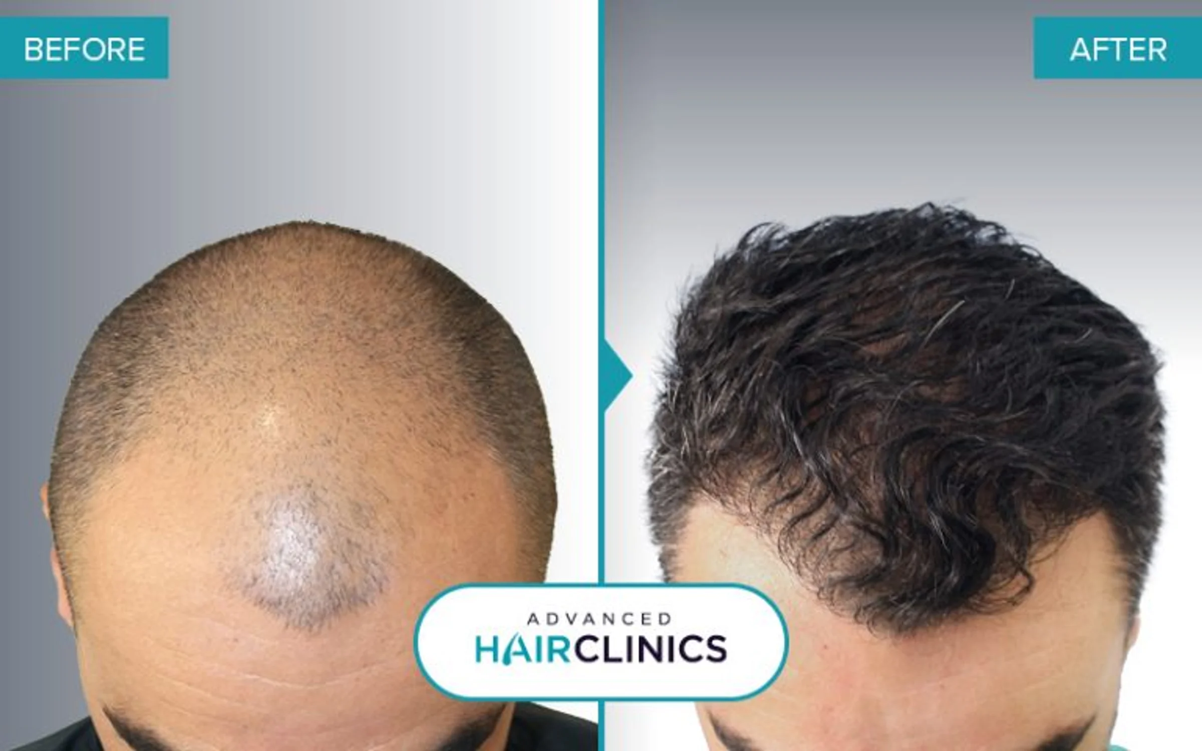 Advanced Hair Clinics, Athens, Greece - Gulfs, Frontal area, Thinning hair - Direct FUE (DHI) : 2318