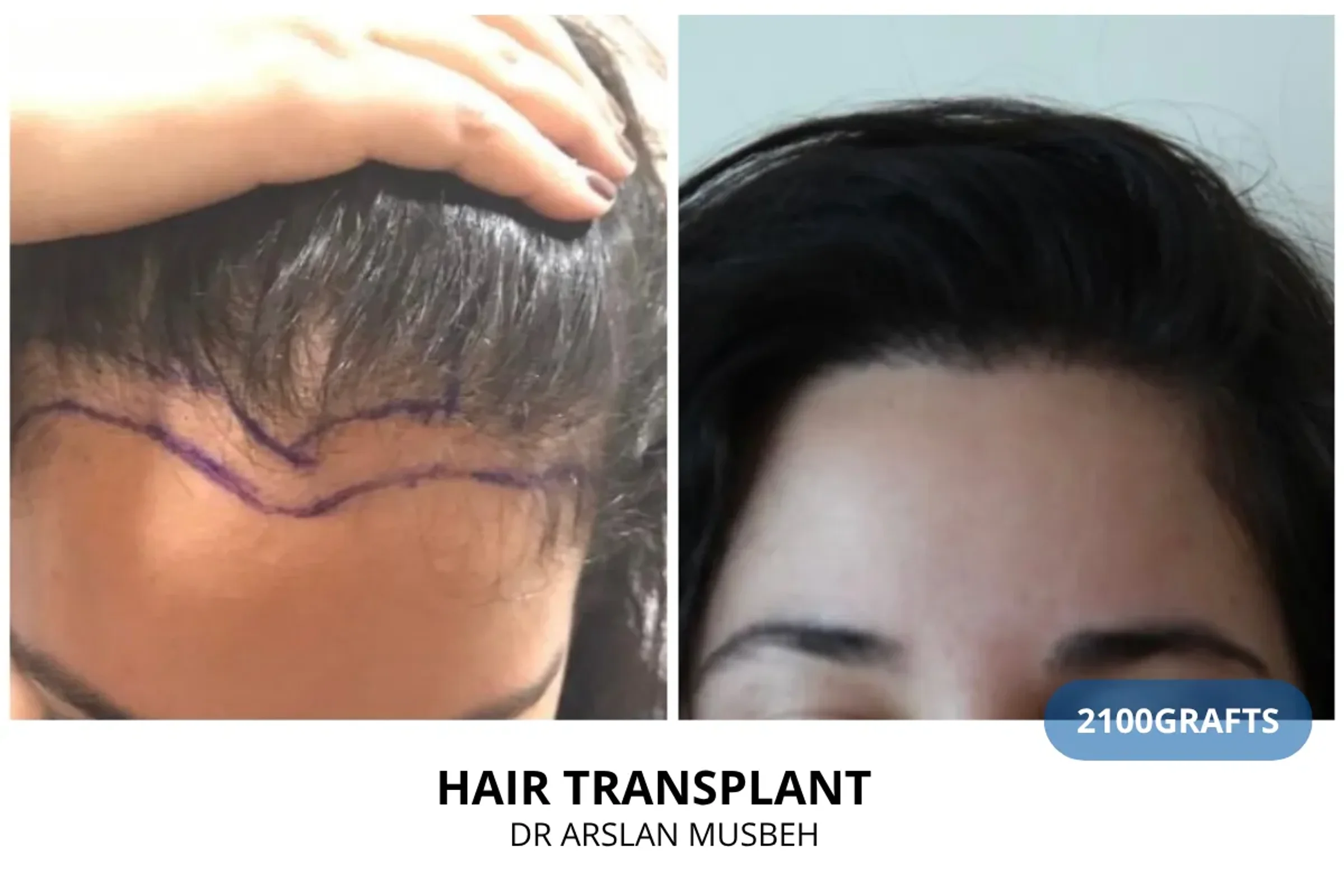 Dr Arslan, HAIRMEDICO, Istanbul, Turkey - Frontal area - FUE motorized : 2100