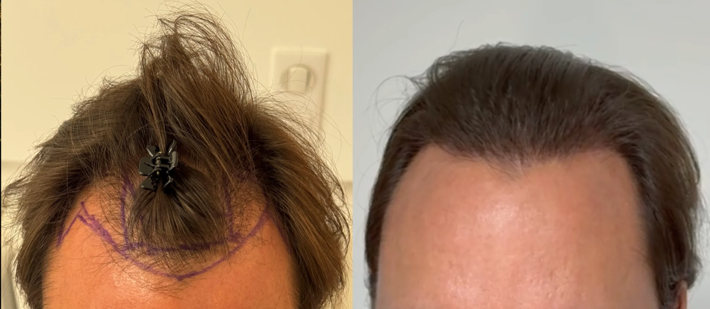 Dr Sabatier, Hexagone clinic, Nice, France - Gulfs - FUE motorized, FUE long hair : 800