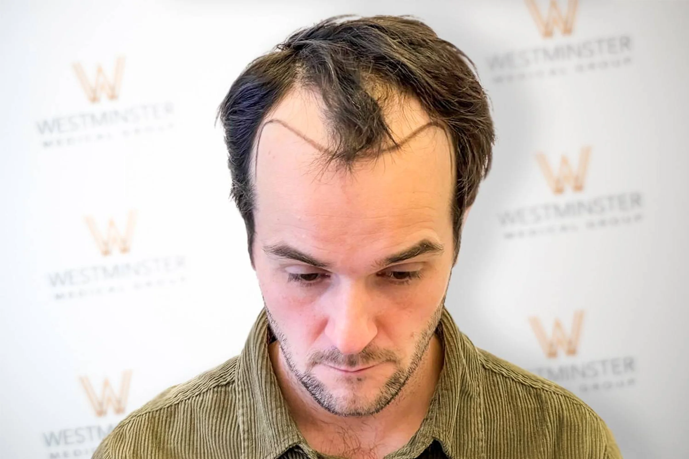 Westminster Medical Group, London, United Kingdom - Gulfs, Frontal area - FUE motorized : 2879